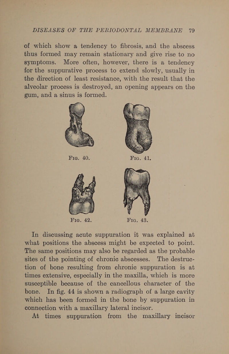 of which show a tendency to fibrosis, and the abscess thus formed may remain stationary and give rise to no symptoms. More often, however, there is a tendency for the suppurative process to extend slowly, usually in the direction of least resistance, with the result that the alveolar process is destroyed, an opening appears on the gum, and a sinus is formed. In discussing acute suppuration it was explained at what positions the abscess might be expected to point. The same positions may also be regarded as the probable sites of the pointing of chronic abscesses. The destruc- tion of bone resulting from chronic suppuration is at times extensive, especially in the maxilla, which is more susceptible because of the cancellous character of the bone. In fig. 44 is shown a radiograph of a large cavity which has been formed in the bone by suppuration in connection with a maxillary lateral incisor. At times suppuration from the maxillary incisor