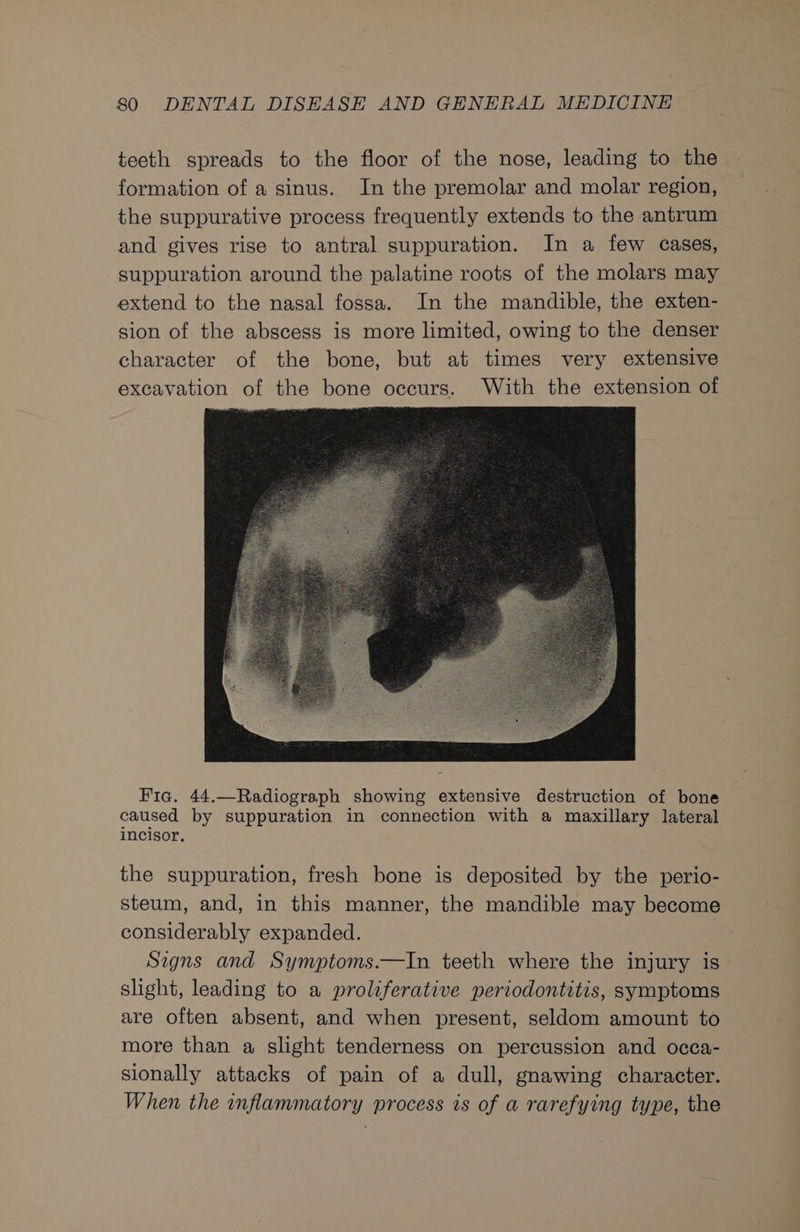 teeth spreads to the floor of the nose, leading to the formation of a sinus. In the premolar and molar region, the suppurative process frequently extends to the antrum and gives rise to antral suppuration. In a few cases, suppuration around the palatine roots of the molars may extend to the nasal fossa. In the mandible, the exten- sion of the abscess is more limited, owing to the denser character of the bone, but at times very extensive excavation of the bone occurs. With the extension of Fic. 44.—Radiograph showing extensive destruction of bone caused by suppuration in connection with a maxillary lateral incisor, the suppuration, fresh bone is deposited by the perio- steum, and, in this manner, the mandible may become considerably expanded. Signs and Symptoms.—In teeth where the injury is slight, leading to a proliferative periodontitis, symptoms are often absent, and when present, seldom amount to more than a slight tenderness on percussion and occa- sionally attacks of pain of a dull, gnawing character. When the inflammatory process is of a rarefying type, the