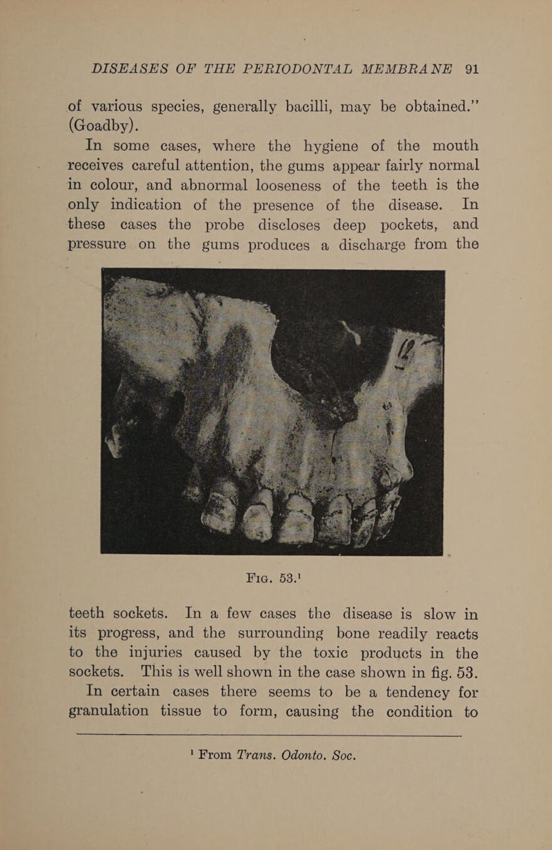 of various species, generally bacilli, may be obtained.” (Goadby). In some cases, where the hygiene of the mouth receives careful attention, the gums appear fairly normal in colour, and abnormal looseness of the teeth is the only indication of the presence of the disease. In these cases the probe discloses deep pockets, and pressure on the gums produces a discharge from the teeth sockets. In a few cases the disease is slow in its progress, and the surrounding bone readily reacts to the injuries caused by the toxic products in the sockets. This is well shown in the case shown in fig. 53. In certain cases there seems to be a tendency for granulation tissue to form, causing the condition to