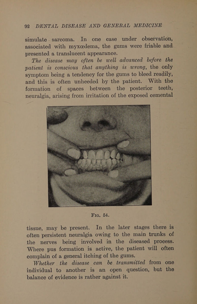 simulate. sarcoma. In one case under observation, associated with myxcedema, the gums were friable and presented a translucent appearance. The disease may often be well advanced before the patient ts conscious that anything is wrong, the only symptom being a tendency for the gums to bleed readily, and this is often unheeded by the patient. With the formation of spaces between the posterior teeth, neuralgia, arising from irritation of the exposed cemental — tissue, may be present. In the later stages there is often persistent neuralgia owing to the main trunks of the nerves being involved in the diseased process. Where pus formation is active, the patient will often complain of a general itching of the gums. Whether the disease can be transmitted from one individual to another is an open question, but the balance of evidence is rather against it.