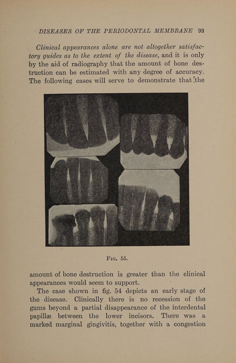 Clinical appearances alone are not altogether satisfac- tory guides as to the extent of the disease, and it is only by the aid of radiography that the amount of bone des- truction can be estimated with any degree of accuracy. The following cases will serve to demonstrate that ‘the amount of bone destruction is greater than the clinical appearances would seem to support. The case shown in fig. 54 depicts an early stage of the disease. Clinically there is no recession of the gums beyond a partial disappearance of the interdental papilla between the lower incisors. There was a marked marginal gingivitis, together with a congestion