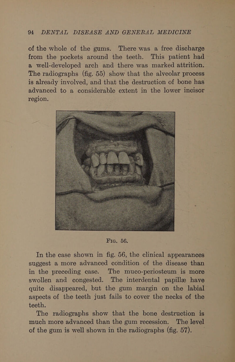 of the whole of the gums. There was a free discharge from the pockets around the teeth. This patient had a well-developed arch and there was marked attrition. The radiographs (fig. 55) show that the alveolar process is already involved, and that the destruction of bone has advanced to a considerable extent in the lower incisor region. In the case shown in fig. 56, the clinical appearances suggest a more advanced condition of the disease than in the preceding case. The muco-periosteum is more swollen and congested. The interdental papille have quite disappeared, but the gum margin on the labial aspects of the teeth just fails to cover the necks of the teeth. : The radiographs show that the bone destruction is much more advanced than the gum recession. The level of the gum is well shown in the radiographs (fig. 57).