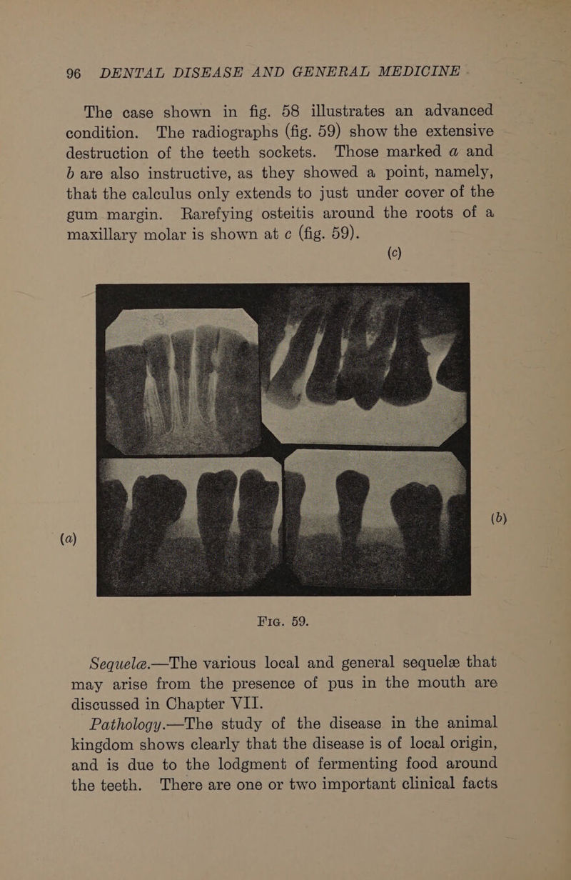 The case shown in fig. 58 illustrates an advanced condition. The radiographs (fig. 59) show the extensive destruction of the teeth sockets. Those marked a and b are also instructive, as they showed a point, namely, that the calculus only extends to just under cover of the gum margin. Rarefying osteitis around the roots of a maxillary molar is shown at c (fig. 59). (0) Sequel@.—The various local and general sequelz that may arise from the presence of pus in the mouth are discussed in Chapter VII. Pathology.—The study of the disease in the animal kingdom shows clearly that the disease is of local origin, and is due to the lodgment of fermenting food around the teeth. There are one or two important clinical facts