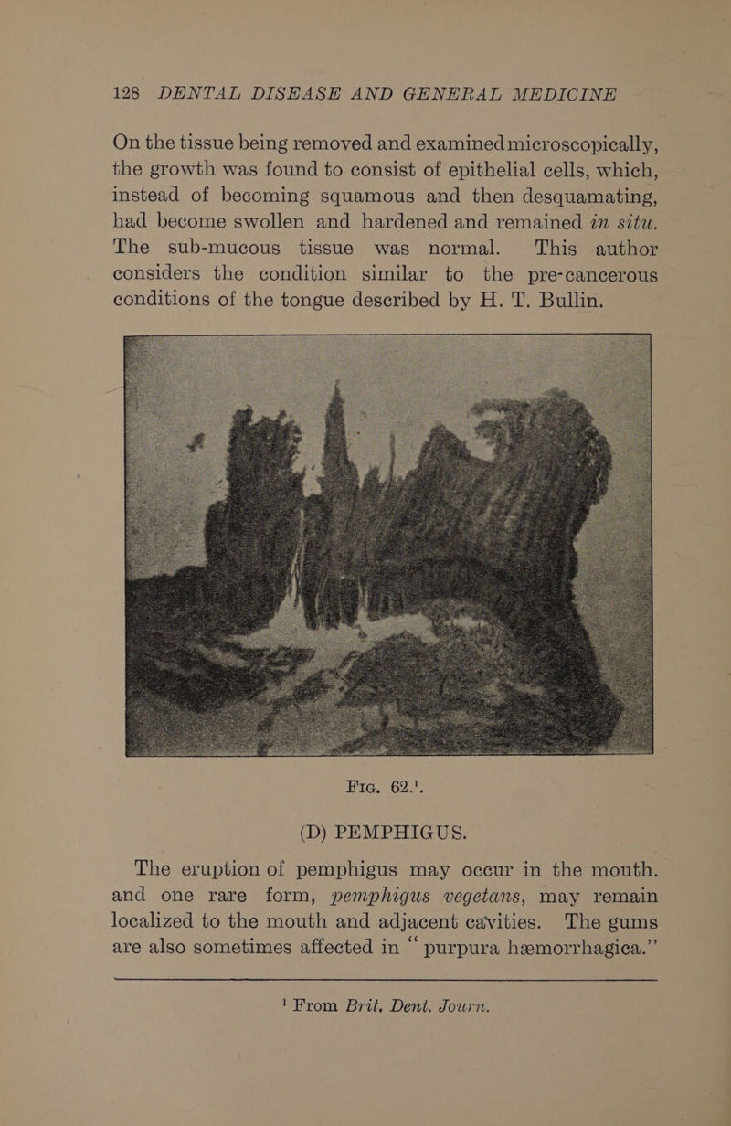 On the tissue being removed and examined microscopically, the growth was found to consist of epithelial cells, which, instead of becoming squamous and then desquamating, had become swollen and hardened and remained in sztw. The sub-mucous tissue was normal. This author considers the condition similar to the pre-cancerous conditions of the tongue described by H. T. Bullin. (D) PEMPHIGUS. The eruption of pemphigus may occur in the mouth. and one rare form, pemphigus vegetans, may remain localized to the mouth and adjacent cavities. The gums are also sometimes affected in “ purpura hemorrhagica.”’ 1From Brit. Dent. Journ.