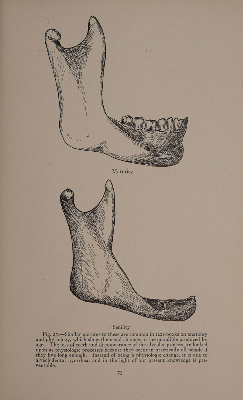 Senility Fig, 25.—Similar pictures to these are common in text-books on anatomy and physiology, which show the usual changes in the mandible produced by age. The loss of teeth and disappearance of the alveolar process are looked upon as physiologic processes because they occur in practically all people if they live long enough. Instead of being a physiologic change, it is due to alveolodental pyorrhea, and in the light of our present knowledge is pre- ventable. rhs