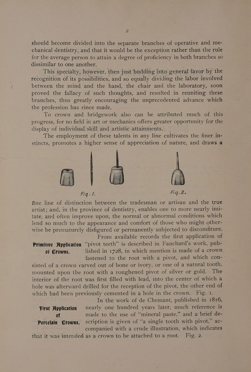 should become divided into the separate branches of operative and me- chanical dentistry, and that it would be the exception rather than the rule for the average person to attain a degree of proficiency in both branches so dissimilar to one another. This specialty, however, then just budding into general favor by the recognition of its possibilities, and so equally dividing the labor involved between the mind and the hand, the chair and the laboratory, soon proved the fallacy of such thoughts, and resulted in reuniting these branches, thus greatly encouraging the unprecedented advance which the profession has since made. To crown and bridgework also can be attributed much of this progress, for no field in art or mechanics offers greater opportunity for the display of individual skill and artistic attainments. The employment of these talents in any line cultivates the finer in- stincts, promotes a higher sense of appreciation of nature, and draws a Fig cath FiG=es fine line of distinction between the tradesman or artisan and the true artist; and, in the province of dentistry, enables one to more nearly imi- tate, and often improve upon, the normal or abnormal conditions which lend so much to the appearance and comfort of those who might other- wise be prematurely disfigured or permanently subjected to discomfiture- From available records the first application of Primitive Application “pivot teeth” is described in Fauchard’s work, pub- of Crowns, lished in 1728, in which mention is made of a crown fastened to the root with a pivot, and which con- sisted of a crown carved out of bone or ivory, or one of a natural tooth, mounted upon the root with a roughened pivot of silver or gold. - The interior of the root was first filled with lead, into the center of which a hole was afterward drilled for the reception of the pivot, the other end of which had been previously cemented in a hole in the crown. Fig. 1. In the work of de Chemant, published in 1816, First Application nearly one hundred years later, much reference is of made to the use of “mineral paste,” and a brief de- Porcelain Growns, scription is given of “a single tooth with pivot,” ac- companied with a crude illustration, which indicates that it was intended as a crown to be attached to a root. Fig. 2.