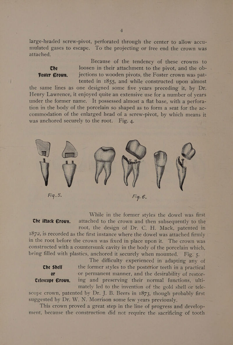 large-headed screw-pivot, perforated through the center to allow accu- mulated gases to escape. To the projecting or free end the crown was attached. Because of the tendency of these crowns to Che loosen in their attachment to the pivot, and the ob- Foster Crown. jections to wooden pivots, the Foster crown was pat- tented in 1855, and while constructed upon almost the same lines as one designed some five years preceding it, by Dr. Henry Lawrence, it enjoyed quite an extensive use for a number of years under the former name. It possessed almost a flat base, with a perfora- tion in the body of the porcelain so shaped as to form a seat for the ac- commodation of the enlarged head of a screw-pivot, by which means it was anchored securely to the root. Fig. 4. While in the former styles the dowel was first Che Mack Grown. attached to the crown and then subsequently to the root, «the design of- Dr: C. H Wack, patemredein 1872, is recorded as the first instance where the dowel was attached firmly in the root before the crown was fixed in place upon it. The crown was constructed with a countersunk cavity in the body of the porcelain which, being filled with plastics, anchored it securely when mounted. Fig. 5. The difficulty experienced in adapting any of The Shell the former styles to the posterior teeth in a practical or or permanent manner, and the desirability of restor- Telescope Grown. ing and preserving their normal functions, ulti- mately led to the invention of the gold shell or tele- scope crown, patented by Dr. J. B. Beers in 1873, though probably first suggested by Dr. W. N. Morrison some few years previously. This crown proved a great step in the line of progress and develop- ment, because the construction did not require the sacrificing of tooth