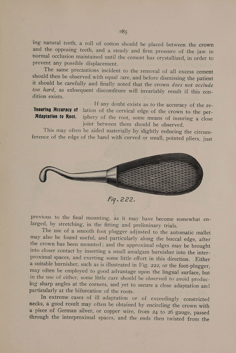 ing natural teeth, a roll of cotton should be placed between the crown and the opposing teeth, and a steady and firm pressure of the jaw in normal occlusion maintained until the cement has crystallized, in order to prevent any possible displacement. The same precautions incident to the removal of all excess cement should then be observed with equal tare, and before dismissing the patient it should be carefully and finally noted that the crown does not occlude too hard, as subsequent discomfiture will invariably result if this con- dition exists. If any doubt exists as to the accuracy of the re- Insuring Accuracy of lation of the cervical edge of the crown to the per- Adaptation to Root. iphery of the root, some means of insuring a close joint between them should be observed. This may often be aided materially-by slightly reducing the circum- ference of the edge of the band with curved or small, pointed pliers, just ' W an —— Nth WH Wi Wi ANN Nk NAAR AA) AAW) i ) ) AN NA iy Fig. Cae. previous to the final mounting, as it may have become somewhat en- larged, by stretching, in the fitting and preliminary trials. The use of a smooth foot plugger adjusted to the automatic mallet may also be found useful, and particularly along the buccal edge, after the crown has been mounted: and the approximal edges may be brought into closer contact by inserting a small amalgam burnisher into the inter- proximal spaces, and exerting some little effort in this direction. Hither a suitable burnisher, such as is illustrated in Fig. 222, or the foot-plugger, may often be employed to good advantage upon the lingual surface, but in the use of either, some little care should be observed to avoid produc- ing sharp angles at the corners, and yet to secure a close adaptation and particularly at the bifurcation of the roots. In extreme cases of ill adaptation or of exceedingly constricted necks, a good result may often be obtained by encircling the crown with a piece of German silver, or copper wire, from 24 to 26 gauge, passed through the interproximal spaces, and the ends then twisted from the