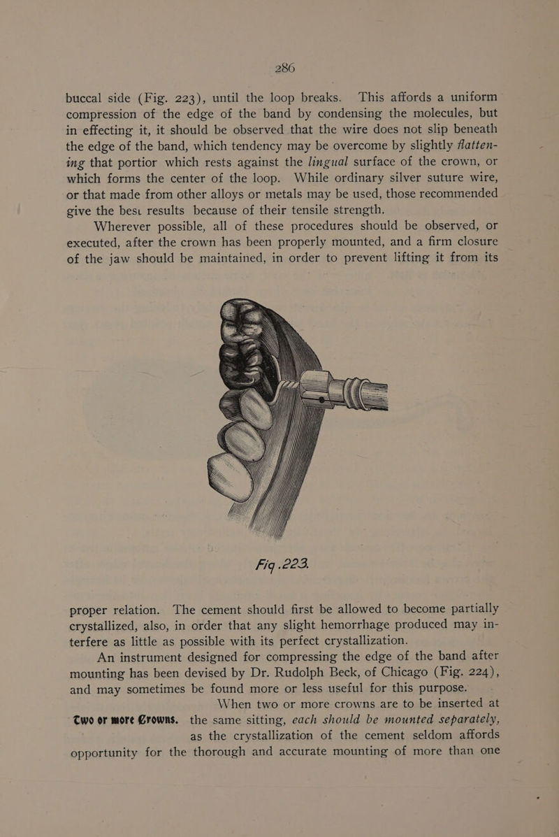 buccal side (Fig. 223), until the loop breaks. This affords a uniform compression of the edge of the band by condensing the molecules, but in effecting it, it should be observed that the wire does not slip beneath the edge of the band, which tendency may be overcome by slightly flatten- ing that portior which rests against the lingual surface of the crown, or which forms the center of the loop. While ordinary silver suture wire, or that made from other alloys or metals may be used, those recommended give the bes: results because of their tensile strength. Wherever possible, all of these procedures should be observed, or executed, after the crown has been properly mounted, and a firm closure of the jaw should be maintained, in order to prevent lifting it from its proper relation. The cement should first be allowed to become partially crystallized, also, in order that any slight hemorrhage produced may in- terfere as little as possible with its perfect crystallization. An instrument designed for compressing the edge of the band after mounting has been devised by Dr. Rudolph Beck, of Chicago (Fig. 224), and may sometimes be found more or less useful for this purpose. When two or more crowns are to be inserted at Two or more Crowns. the same sitting, each should be mounted separately, as the crystallization of the cement seldom affords opportunity for the thorough and accurate mounting of more than one
