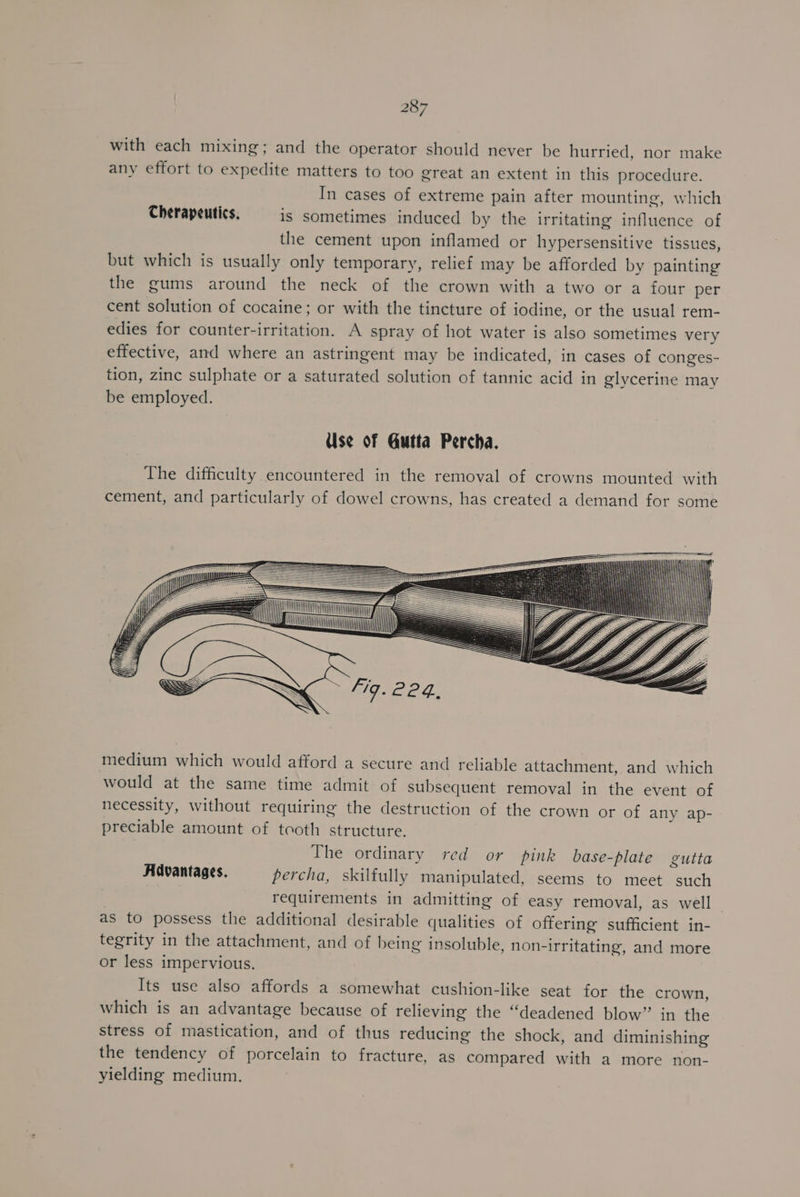 with each mixing; and the operator should never be hurried, nor make any effort to expedite matters to too great an extent in this procedure. In cases of extreme pain after mounting, which Cherapeutics. is sometimes induced by the irritating influence of the cement upon inflamed or hypersensitive tissues, but which is usually only temporary, relief may be afforded by painting the gums around the neck of the crown with a two or a four per cent solution of cocaine; or with the tincture of iodine, or the usual rem- edies for counter-irritation. A spray of hot water is also sometimes very effective, and where an astringent may be indicated, in cases of conges- tion, zinc sulphate or a saturated solution of tannic acid in glycerine may be employed. Use of Gutta Percha. The difficulty encountered in the removal of crowns mounted with cement, and particularly of dowel crowns, has created a demand for some i) ht LT | medium which would afford a secure and reliable attachment, and which would at the same time admit of subsequent removal in the event of necessity, without requiring the destruction of the crown or of any ap- preciable amount of tooth structure. The ordinary red or pink base-plate gutta Advantages, percha, skilfully manipulated, seems to meet such requirements in admitting of easy removal, as well | as to possess the additional desirable qualities of offering sufficient in- tegrity in the attachment, and of being insoluble, non-irritating, and more or less impervious. Its use also affords a somewhat cushion-like seat for the crown, which is an advantage because of relieving the “deadened blow” in the stress of mastication, and of thus reducing the shock, and diminishing the tendency of porcelain to fracture, as compared with a more non- yielding medium.