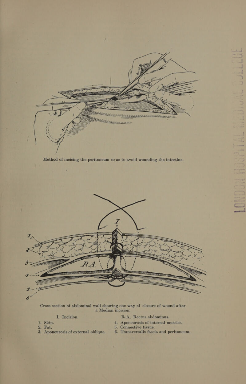 OTT wn 2 eee AUNT —~ KHANNA .-- 4a ieee SS (fe Sa TTT 4 ie ee ae —=—~- 2s = — : 2 ___ aa = Se ean Se —— ——s SSeS —<— ——— — 7 _———- — Cross section of abdominal wall showing-one way of closure of wound after a Median incision. I. Incision. R.A, Rectus abdominus. 1. Skin. 4. Aponeurosis of internal muscles. 2. Fat. 5. Connective tissue.