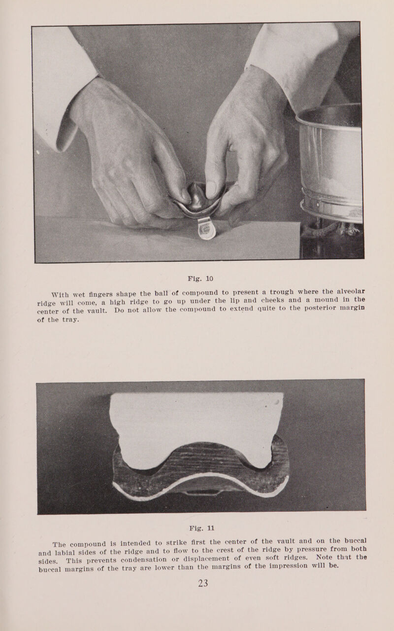 With wet fingers shape the ball of compound to present a trough where the alveolar ridge will come, a high ridge to go up under the lip and cheeks and a mound in the center of the vault. Do not allow the compound to extend quite to the posterior margin of the tray. The compound is intended to strike first the center of the vault and on the buccal and labial sides of the ridge and to flow to the crest of the ridge by pressure from both sides. This prevents condensation or displacement of even soft ridges. Note that the al margins of the tray are lower than the margins of the impression will be. UES buce