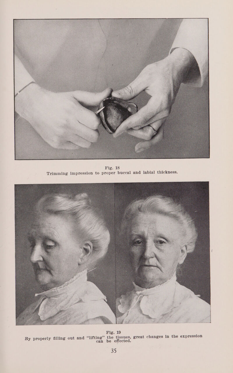 Fig. 18 Trimming impression to proper buccal and labial thickness. YH HOE: Fig. 19 By properly filling out and ‘lifting’ the tissues, great changes in the expression can be effected.