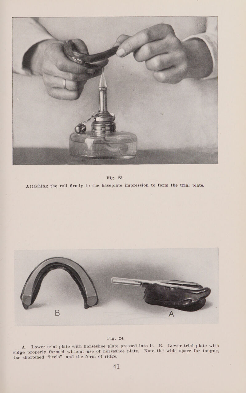 ~ ica Zes Attaching the roll firmly to the baseplate impression to form the trial plate. y A. Lower trial plate with horseshoe plate pressed into it. B. Lower trial plate with ridge properly formed without use of horseshoe plate. Note the wide space for tongue, the shortened “heels”, and the form of ridge.