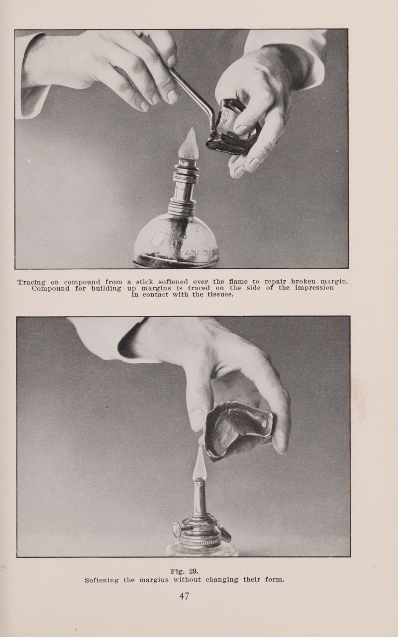 Tracing on compound from a stick softened over the flame to repair broken margin. Compound for building up margins is traced on the side of the impression in contact with the tissues.