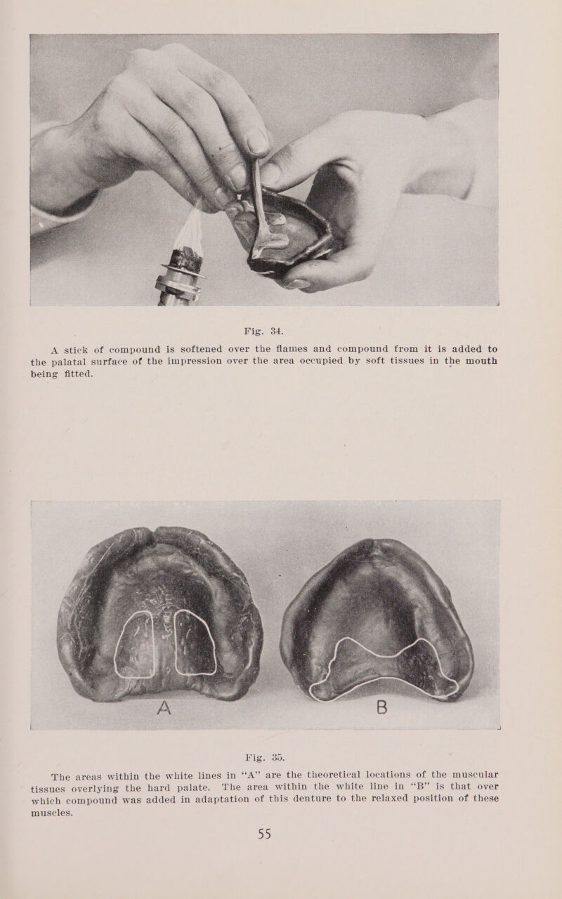 A stick of compound is softened over the flames and compound from it is added to the palatal surface of the impression over the area occupied by soft tissues in the mouth being fitted. E The areas within the white lines in ‘‘A” are the theoretical locations of the muscular tissues overlying the hard palate. The area within the white line in “B” is that over which compound was added in adaptation of this denture to the relaxed position of these muscles. 5)