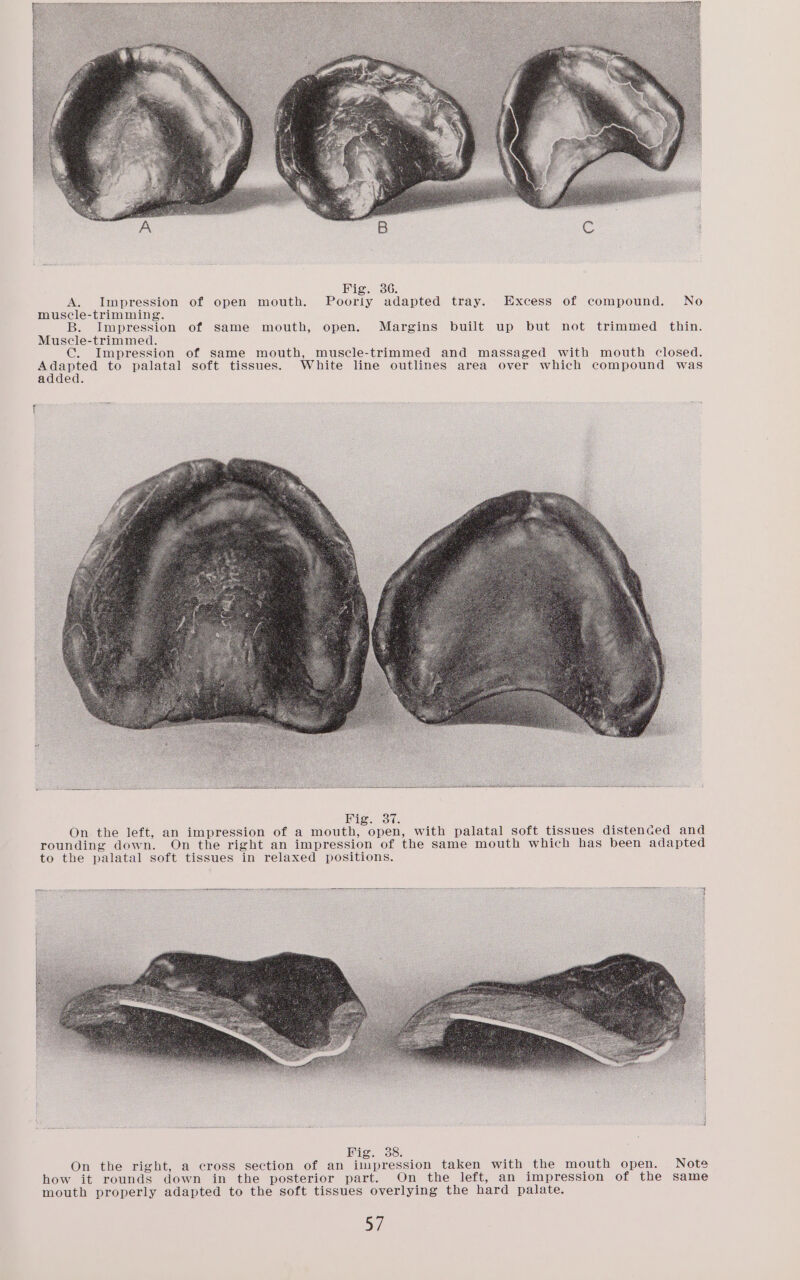 A. Impression of open mouth. Poorly adapted tray. Excess of compound. No muscle-trimming. B. Impression of same mouth, open. Margins built up but not trimmed thin. Muscle-trimmed. C. Impression of same mouth, muscle-trimmed and massaged with mouth closed. paved to palatal soft tissues. White line outlines area over which compound was added. Soe On the left, an impression of a mouth, open, with palatal soft tissues distenced and rounding down. On the right an impression of the same mouth which has been adapted to the palatal soft tissues in relaxed positions. NaS, Brst- On the right, a cross section of an impression taken with the mouth open. Note how it rounds down in the posterior part. On the left, an impression of the same mouth properly adapted to the soft tissues overlying the hard palate.