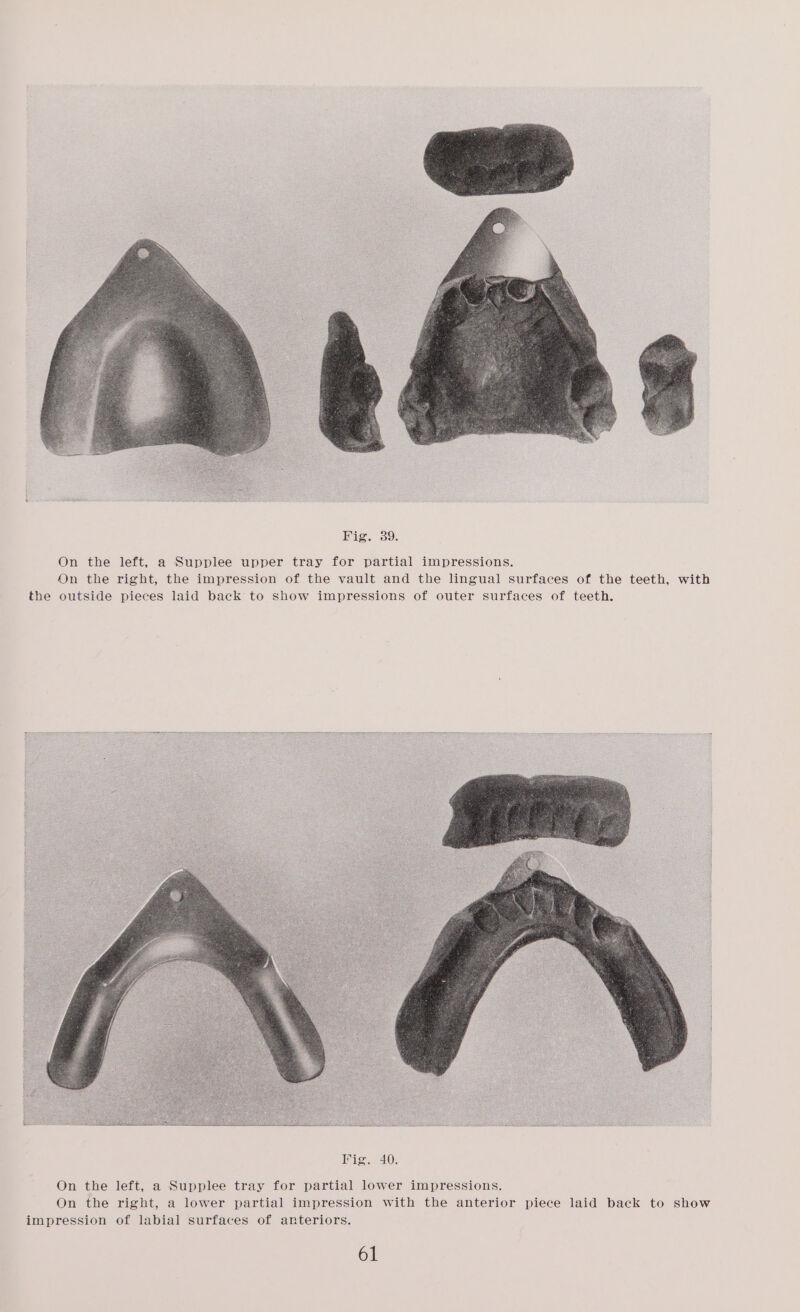 On the left, a Supplee upper tray for partial impressions. On the right, the impression of the vault and the lingual surfaces of the teeth, with the outside pieces laid back to show impressions of outer surfaces of teeth. On the left, a Supplee tray for partial lower impressions. On the right, a lower partial impression with the anterior piece laid back to show impression of labial surfaces of anteriors.