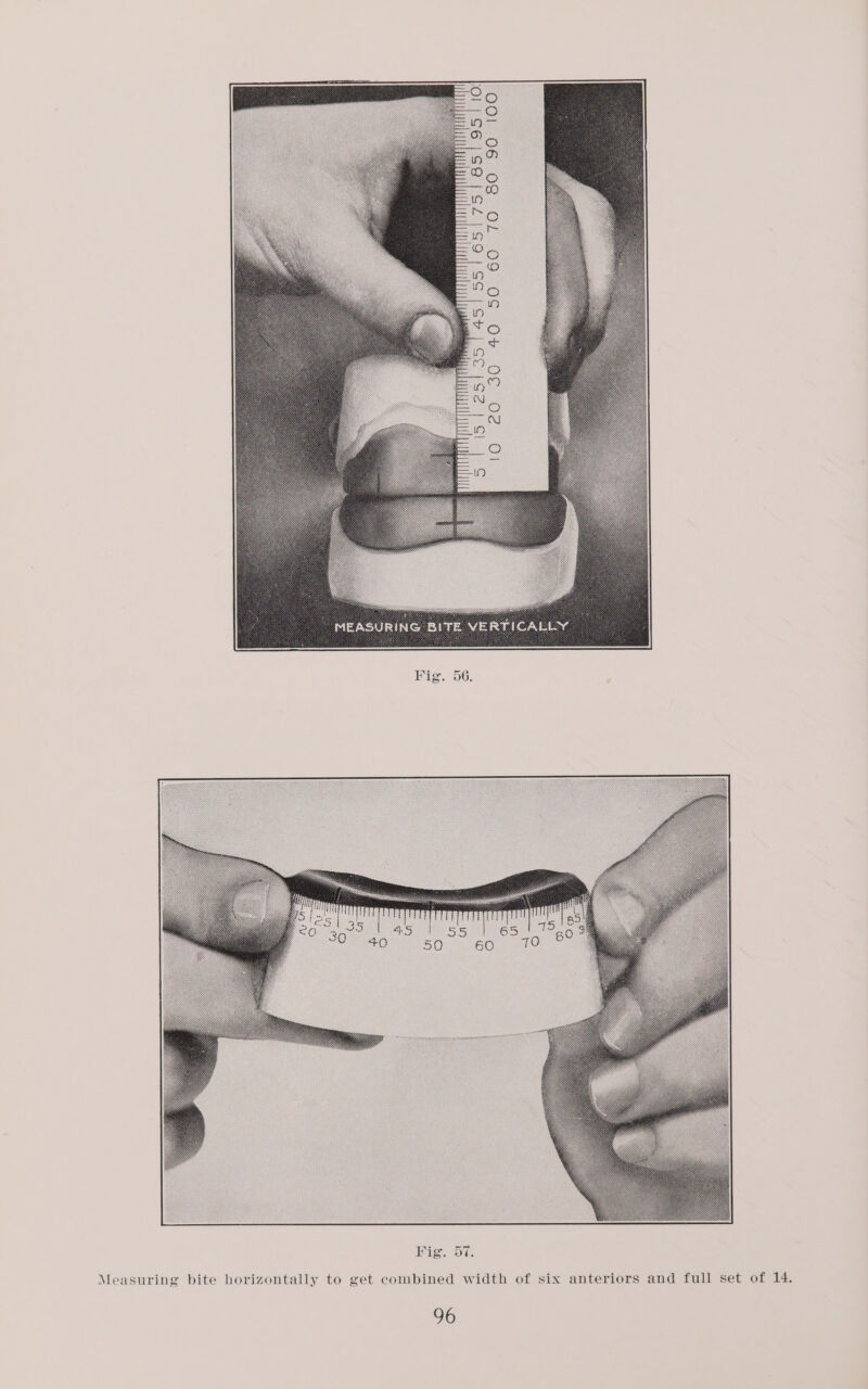 100 351451 551651751 685195 26 | Measuring bite horizontally to get combined width of six anteriors and 96 &lt; “ S _ - ~ ~ SC oO full set of 14.