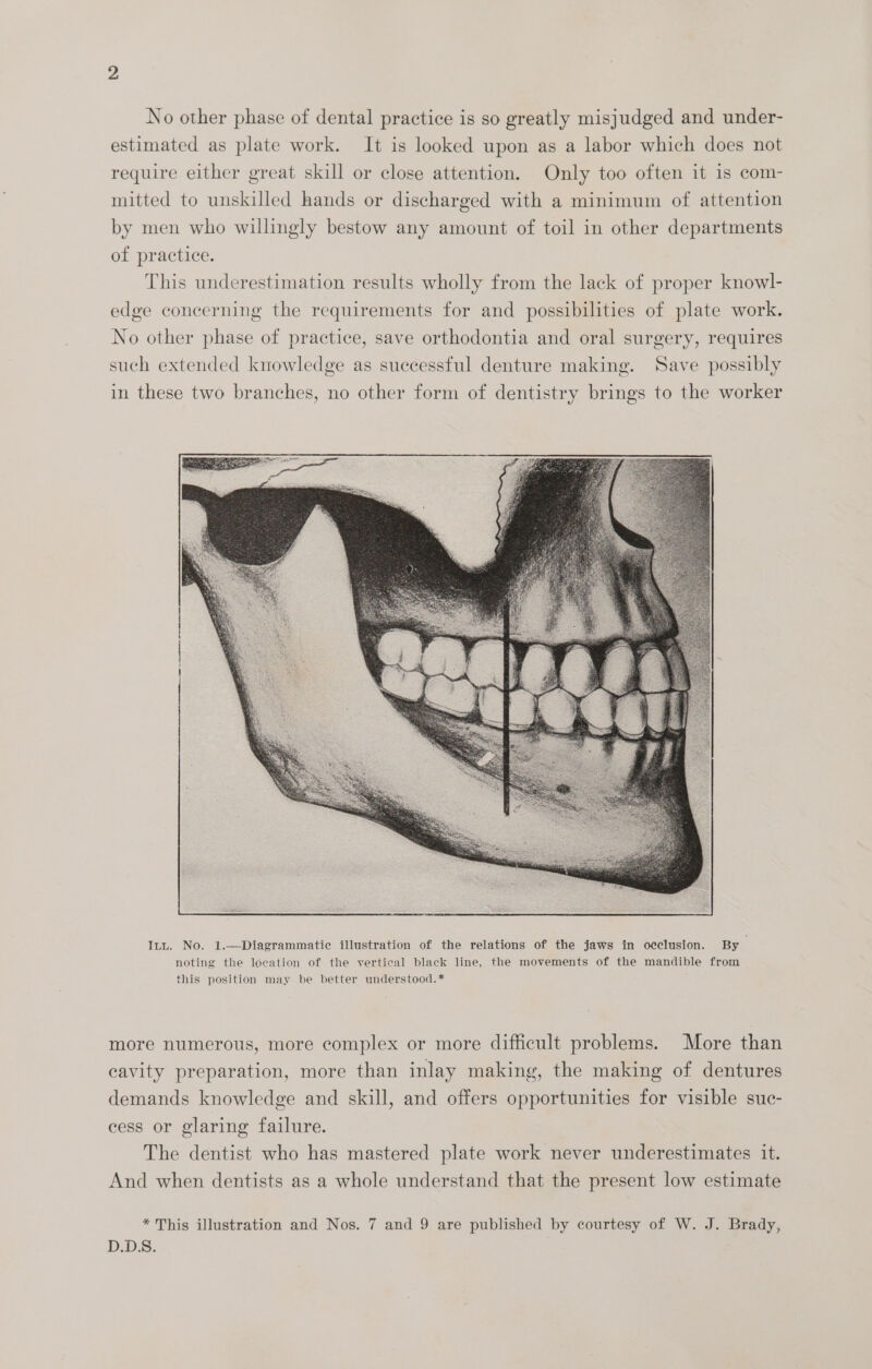 No other phase of dental practice is so greatly misjudged and under- estimated as plate work. It is looked upon as a labor which does not require either great skill or close attention. Only too often it is com- mitted to unskilled hands or discharged with a minimum of attention by men who willingly bestow any amount of toil in other departments of practice. This underestimation results wholly from the lack of proper knowl- edge concerning the requirements for and possibilities of plate work. No other phase of practice, save orthodontia and oral surgery, requires such extended knowledge as successful denture making. Save possibly in these two branches, no other form of dentistry brings to the worker Inu. No. 1.—Diagrammatie illustration of the relations of the jaws in occlusion. By noting the location of the vertical black line, the movements of the mandible from this position may be better understood. * more numerous, more complex or more difficult problems. More than cavity preparation, more than inlay making, the making of dentures demands knowledge and skill, and offers opportunities for visible suc- cess or glaring failure. The dentist who has mastered plate work never underestimates it. And when dentists as a whole understand that the present low estimate * This illustration and Nos. 7 and 9 are published by courtesy of W. J. Brady, D.DS.