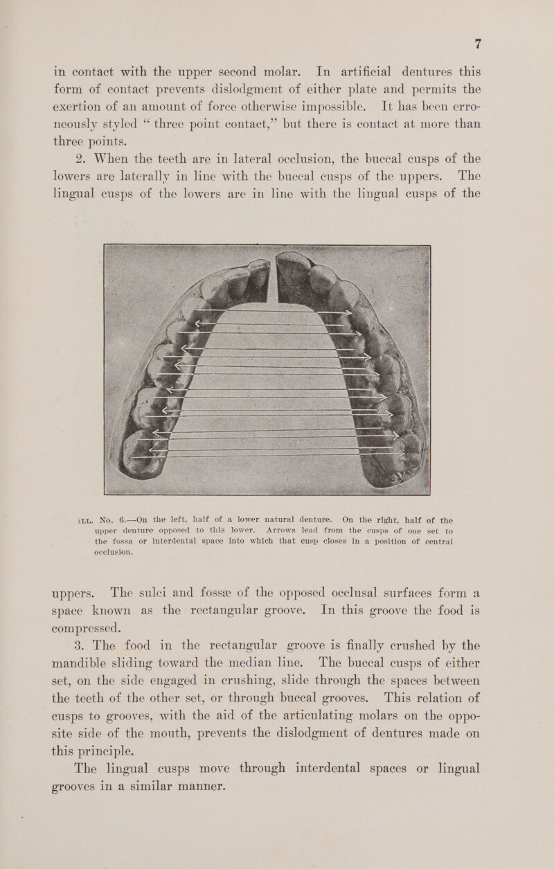 in contact with the upper second molar. In artificial dentures this form of contact prevents dislodgment of either plate and permits the exertion of an amount of force otherwise impossible. It has been erro- neously styled “ three point contact,” but there is contact at more than three points. 2. When the teeth are in lateral occlusion, the buccal cusps of the lowers are laterally in line with the buccal cusps of the uppers. The lingual cusps of the lowers are in line with the lingual cusps of the imu. No. 6.—On the left, half of a lower natural denture. On the right, half of the upper denture opposed to this lower. Arrows lead from the cusps of one set to the fossa or interdental space into which that cusp closes in a position of central occlusion. uppers. The sulci and fossee of the opposed occlusal surfaces form a space known as the rectangular groove. In this groove the food is compressed. 3. The food in the rectangular groove is finally crushed by the mandible sliding toward the median line. ‘The buccal cusps of either set, on the side engaged in crushing, slide through the spaces between the teeth of the other set, or through buccal grooves. This relation of cusps to grooves, with the aid of the articulating molars on the oppo- site side of the mouth, prevents the dislodgment of dentures made on this principle. The lingual cusps move through interdental spaces or lingual grooves in a similar manner.