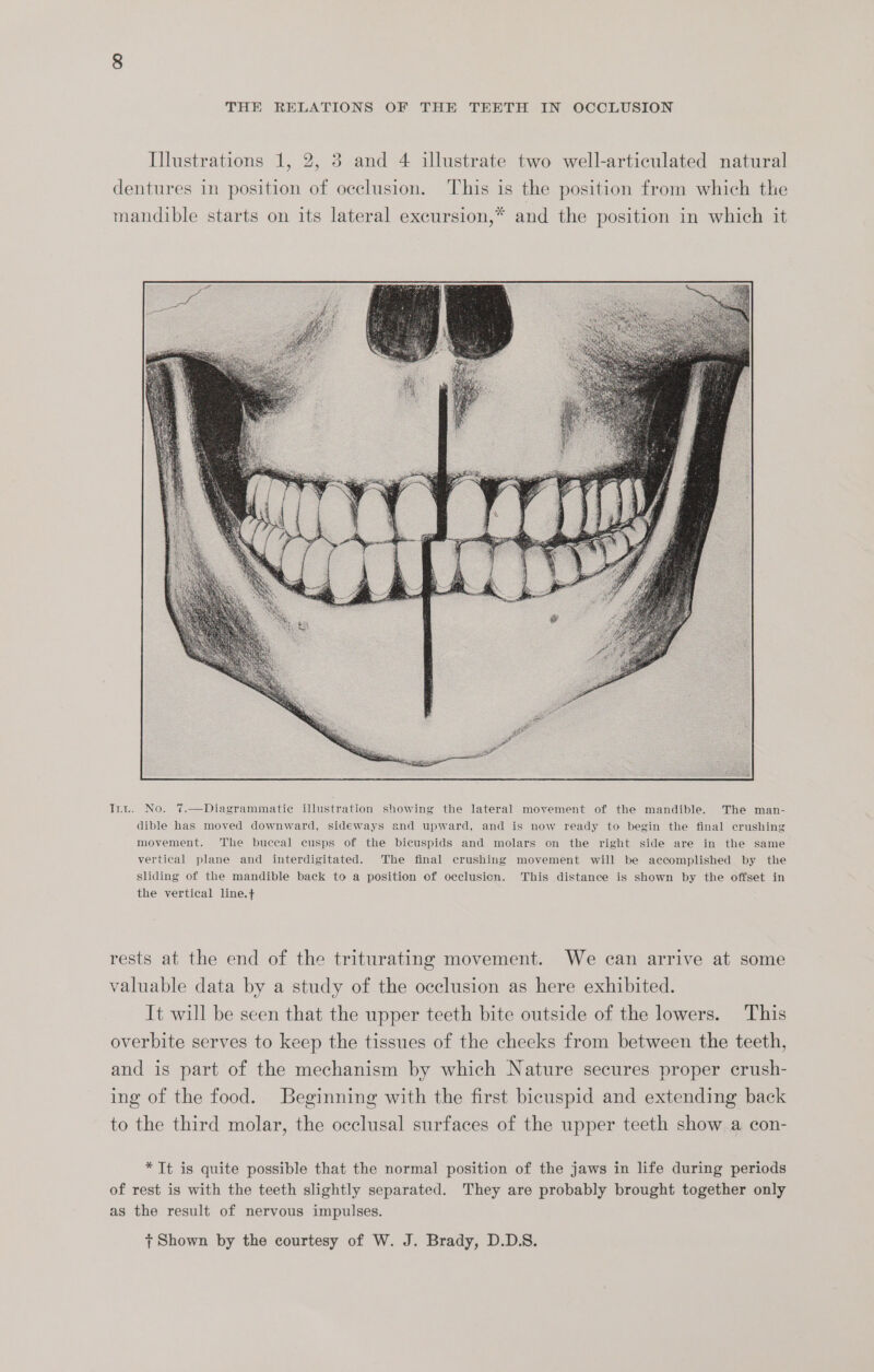 THE RELATIONS OF THE TEETH IN OCCLUSION Illustrations 1, 2, 3 and 4 illustrate two well-articulated natural dentures in position of occlusion. This is the position from which the mandible starts on its lateral excursion,* and the position in which it Inu. No. 7.—Diagrammatie illustration showing the lateral movement of the mandible. The man- dible has moved downward, sideways and upward, and is now ready to begin the final crushing movement. The buccal cusps of the bicuspids and molars on the right side are in the same vertical plane and interdigitated. The final crushing movement will be accomplished by the sliding of the mandible back to a position of occlusion. This distance is shown by the offset in the vertical line.+ rests at the end of the triturating movement. We can arrive at some valuable data by a study of the occlusion as here exhibited. It will be seen that the upper teeth bite outside of the lowers. This overbite serves to keep the tissues of the cheeks from between the teeth, and is part of the mechanism by which Nature secures proper crush- ing of the food. Beginning with the first bicuspid and extending back to the third molar, the occlusal surfaces of the upper teeth show a con- * It is quite possible that the normal position of the jaws in life during periods of rest is with the teeth slightly separated. They are probably brought together only as the result of nervous impulses.