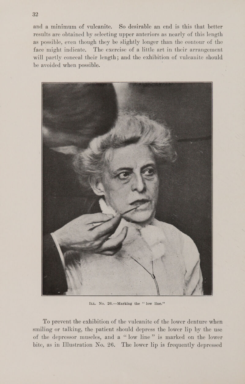 and a minimum of vuleanite. So desirable an end is this that better results are obtained by selecting upper anteriors as nearly of this length as possible, even though they be shghtly longer than the contour of the face might indicate. The exercise of a little art in their arrangement will partly conceal their length; and the exhibition of vulcanite should be avoided when possible. To prevent the exhibition of the vulcanite of the lower denture when smiling or talking, the patient should depress the lower lip by the use of the depressor muscles, and a “ low line” is marked on the lower bite, as in Illustration No. 26. The lower lip is frequently depressed