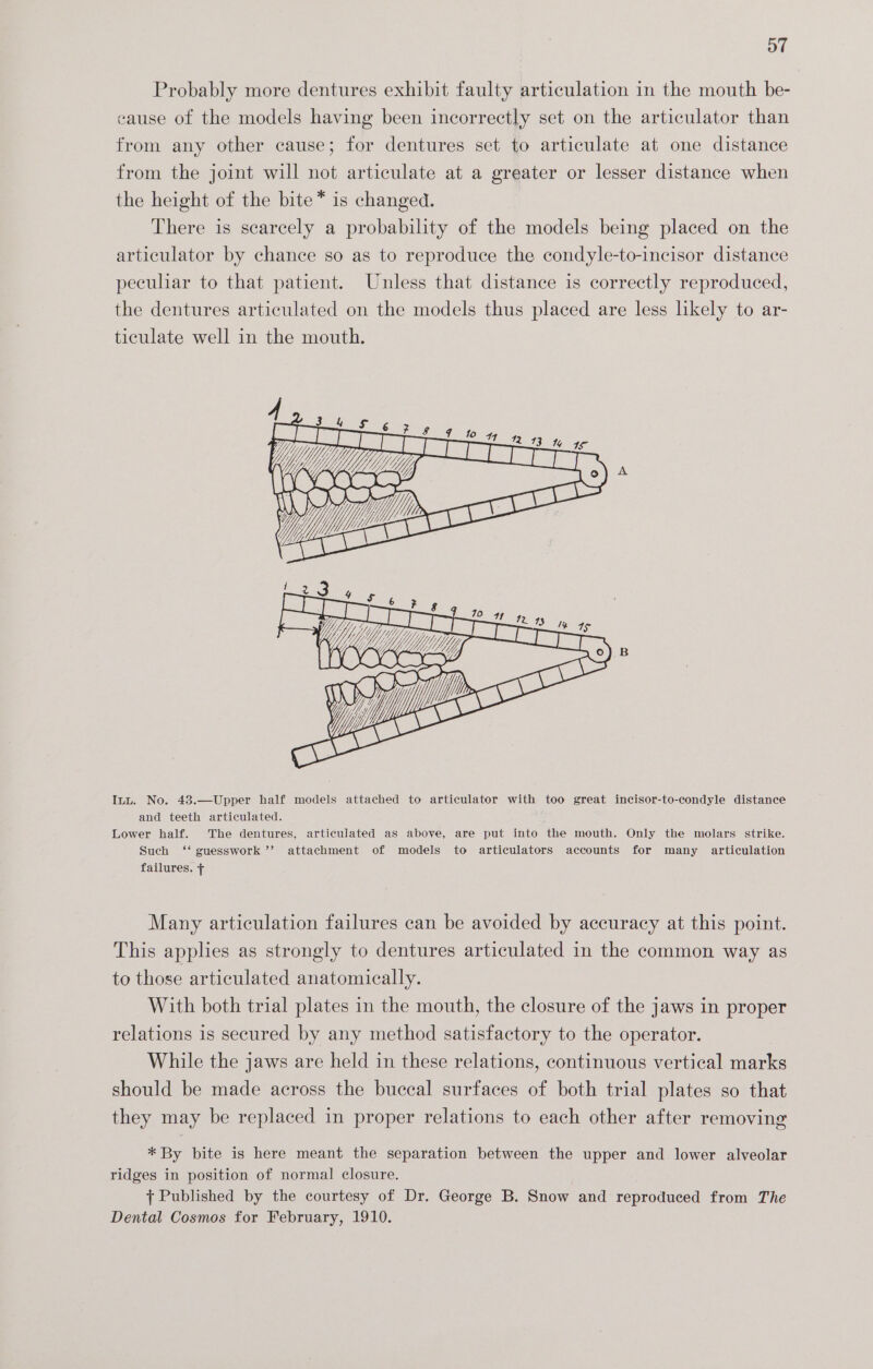 oT Probably more dentures exhibit faulty articulation in the mouth be- cause of the models having been incorrectly set on the articulator than from any other cause; for dentures set to articulate at one distance from the joint will not articulate at a greater or lesser distance when the height of the bite* is changed. There is searcely a probability of the models being placed on the articulator by chance so as to reproduce the condyle-to-incisor distance peculiar to that patient. Unless that distance is correctly reproduced, the dentures articulated on the models thus placed are less likely to ar- ticulate well in the mouth. Inu. No. 43.—Upper half models attached to articulator with too great incisor-to-condyle distance and teeth articulated. Lower half. The dentures, articulated aS above, are put into the mouth. Only the molars strike. Such ‘‘ guesswork ’’ attachment of models to articulators accounts for many articulation failures. Many articulation failures can be avoided by accuracy at this point. This applies as strongly to dentures articulated in the common way as to those articulated anatomically. With both trial plates in the mouth, the closure of the jaws in proper relations is secured by any method satisfactory to the operator. While the jaws are held in these relations, continuous vertical marks should be made across the buccal surfaces of both trial plates so that they may be replaced in proper relations to each other after removing * By bite is here meant the separation between the upper and lower alveolar ridges in position of normal closure. + Published by the courtesy of Dr. George B. Snow and reproduced from The Dental Cosmos for February, 1910.