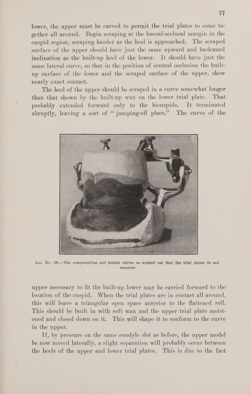 lower, the upper must be carved to permit the trial plates to come to- gether all around. Begin scraping at the buccal-occlusal margin in the cuspid region, scraping harder as the heel is approached. The scraped surface of the upper should have just the same upward and backward inclination as the built-up heel of the lower. It should have just the same lateral curve, so that in the position of central occlusion the built- up surface of the lower and the scraped surface of the upper, show nearly exact contact. The heel of the upper should be scraped in a curve somewhat longer than that shown by the built-up wax on the lower trial plate. That probably extended forward only to the bicuspids. It terminated abruptly, leaving a sort of “ jumping-off place.” The curve of the Itt. No. 58.—The compensating and lateral curves so worked out that the trial plates do not , separate. upper necessary to fit the built-up lower may be carried forward to the location of the cuspid. When the trial plates are in contact all around, this will leave a triangular open space anterior to the flattened roll. This should be built in with soft wax and the upper trial plate moist- ened and closed down on it. This will shape it to conform to the curve in the upper. If, by pressure on the same condyle slot as before, the upper model be now moved laterally, a slight separation will probably occur between the heels of the upper and lower trial plates. This is due to the fact