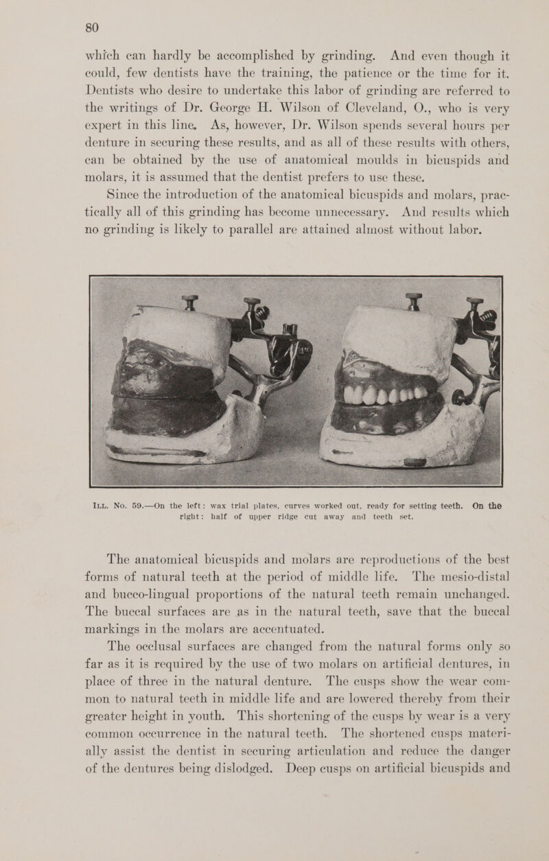 which can hardly be accomplished by grinding. And even though it could, few dentists have the training, the patience or the time for it. Dentists who desire to undertake this labor of grinding are referred to the writings of Dr. George H. Wilson of Cleveland, O., who is very expert in this line, As, however, Dr. Wilson spends several hours per denture in securing these results, and as all of these results with others, ean be obtained by the use of anatomical moulds in bicuspids and molars, it is assumed that the dentist prefers to use these. Since the introduction of the anatomical bicuspids and molars, prac- tically all of this grinding has become unnecessary. And results which no grinding is likely to parallel are attained almost without labor. The anatomical bicuspids and molars are reproductions of the best forms of natural teeth at the period of middle life. The mesio-distal and bueco-lingual proportions of the natural teeth remain unchanged. The buceal surfaces are as in the natural teeth, save that the buccal markings in the molars are accentuated. The occlusal surfaces are changed from the natural forms only so far as it is required by the use of two molars on artificial dentures, in place of three in the natural denture. The cusps show the wear com- mon to natural teeth in middle life and are lowered thereby from their greater height in youth. This shortening of the cusps by wear is a very common occurrence in the natural teeth. The shortened cusps materi- ally assist the dentist in securing articulation and reduce the danger of the dentures being dislodged. Deep cusps on artificial bicuspids and