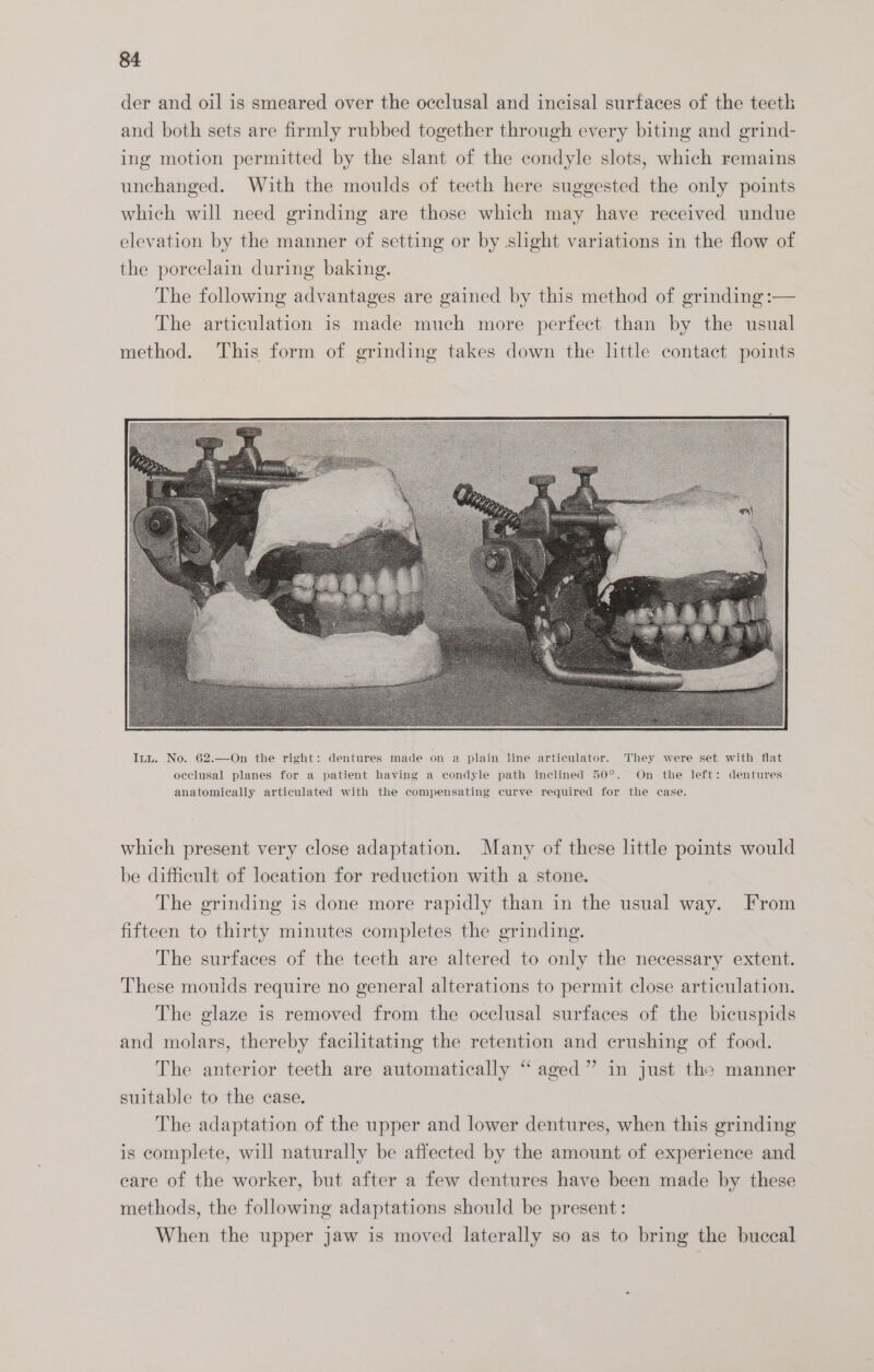 der and oil is smeared over the occlusal and incisal surfaces of the teeth and both sets are firmly rubbed together through every biting and grind- ing motion permitted by the slant of the condyle slots, which remains unchanged. With the moulds of teeth here suggested the only points which will need grinding are those which may have received undue elevation by the manner of setting or by slight variations in the flow of the porcelain during baking. The following advantages are gained by this method of grinding :— The articulation is made much more perfect than by the usual method. This form of grinding takes down the little contact points which present very close adaptation. Many of these little points would be difficult of location for reduction with a stone. The grinding is done more rapidly than in the usual way. From fifteen to thirty minutes completes the grinding. The surfaces of the teeth are altered to only the necessary extent. These moulds require no general alterations to permit close articulation. The glaze is removed from the occlusal surfaces of the bicuspids and molars, thereby facilitating the retention and crushing of food. The anterior teeth are automatically “aged” in just the manner suitable to the case. The adaptation of the upper and lower dentures, when this grinding is complete, will naturally be affected by the amount of experience and eare of the worker, but after a few dentures have been made by these methods, the following adaptations should be present: When the upper jaw is moved laterally so as to bring the buccal