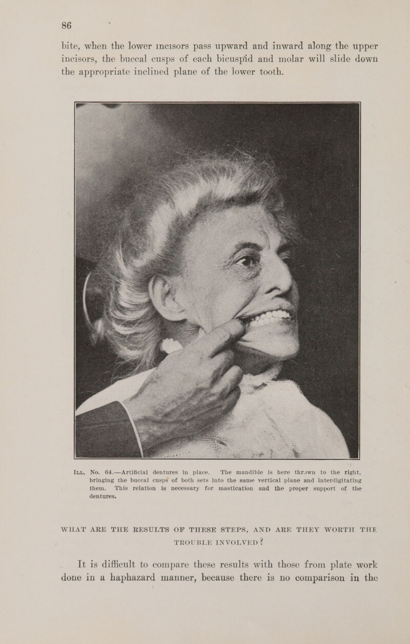 bite, when the lower incisors pass upward and inward along the upper incisors, the buccal cusps of each bicuspid and molar will slide down the appropriate inclined plane of the lower tooth. 64.—Artificial dentures in place. The mandible is here thrown to the right, dentures. WHAT ARE THE RESULTS OF THESE STEPS, AND ARE THEY WORTH THE TROUBLE INVOLVED ¢ It is difficult to compare these results with those from plate work done in a haphazard manner, because there is no comparison in the