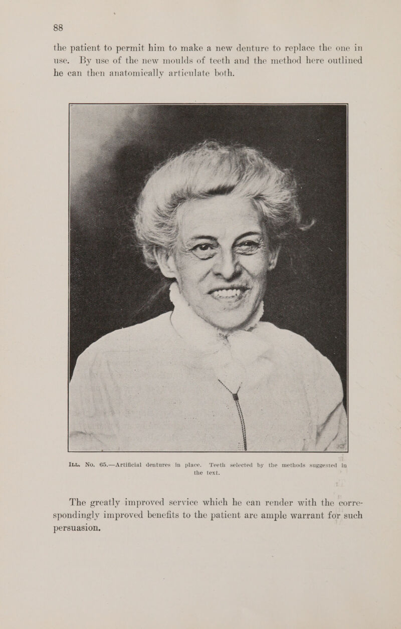 the patient to permit him to make a new denture to replace the one in use. By use of the new moulds of teeth and the method here outlined he can then anatomically articulate both. The greatly improved service which he can render with the corre- spondingly improved benefits to the patient are ample warrant for such persuasion.