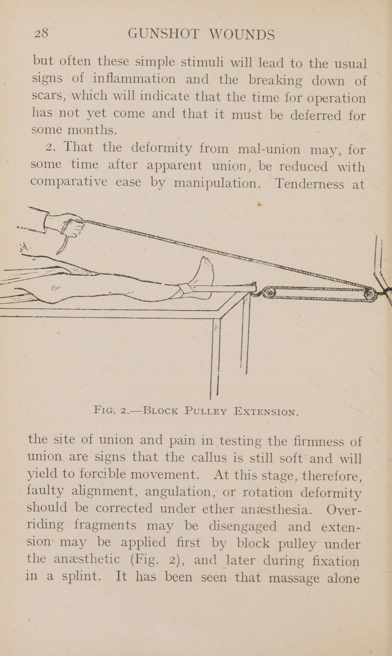 but often these simple stimuli will lead to the usual signs of inflammation and the breaking down of scars, which will indicate that the time for operation has not yet come and that it must be deferred for some months. 2. That the deformity from mal-union may, for some time after apparent union, be reduced with comparative ease by manipulation. Tenderness at Fic, 2.—BLock PuLLtEY EXTENSION. the site of union and pain in testing the firmness of union are signs that the callus is still soft°and will yield to forcible movement. At this stage, therefore, faulty alignment, angulation, or rotation deformity should be corrected under ether anesthesia. Over- riding fragments may be disengaged and exten- sion may be applied first by block pulley under the anesthetic (Fig. 2), and later during fixation in a splint. It has been seen that massage alone