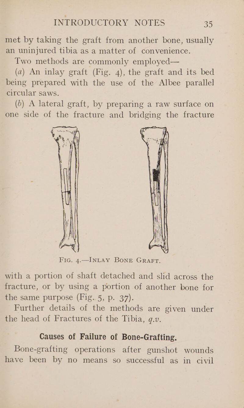 met by taking the graft from another bone, usually an uninjured tibia as a matter of convenience. Two methods are commonly employed— (a) An inlay graft (Fig. 4), the graft and its bed being prepared with the use of the Albee parallel circular saws. (6) A lateral graft, by preparing a raw surface on one side of the fracture and bridging the fracture with a portion of shaft detached and slid across the fracture, or by using a portion of another bone for the same purpose (Fig..5, p. 37). Further details of the methods are given under ene head of Fractures of the Tibia, g.v. Causes of Failure of Bone-Grafting. Bone-grafting operations after gunshot wounds have been by no means so successful as in civil