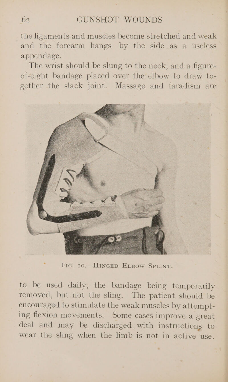 the hgaments and muscles become stretched and weak and the forearm hangs by the side as a useless appendage. The wrist should be slung to the neck, and a figure- of-eight bandage placed over the elbow to draw to- gether the slack joint. Massage and faradism are : Fic. 10.—HINGED ELBow SPLINT. to be used daily, the bandage being temporarily removed, but not the sling. The patient should be encouraged to stimulate the weak muscles by attempt- ing flexion movements. Some cases improve a great deal and may be discharged with instructions to wear the sling when the limb is not in active use.