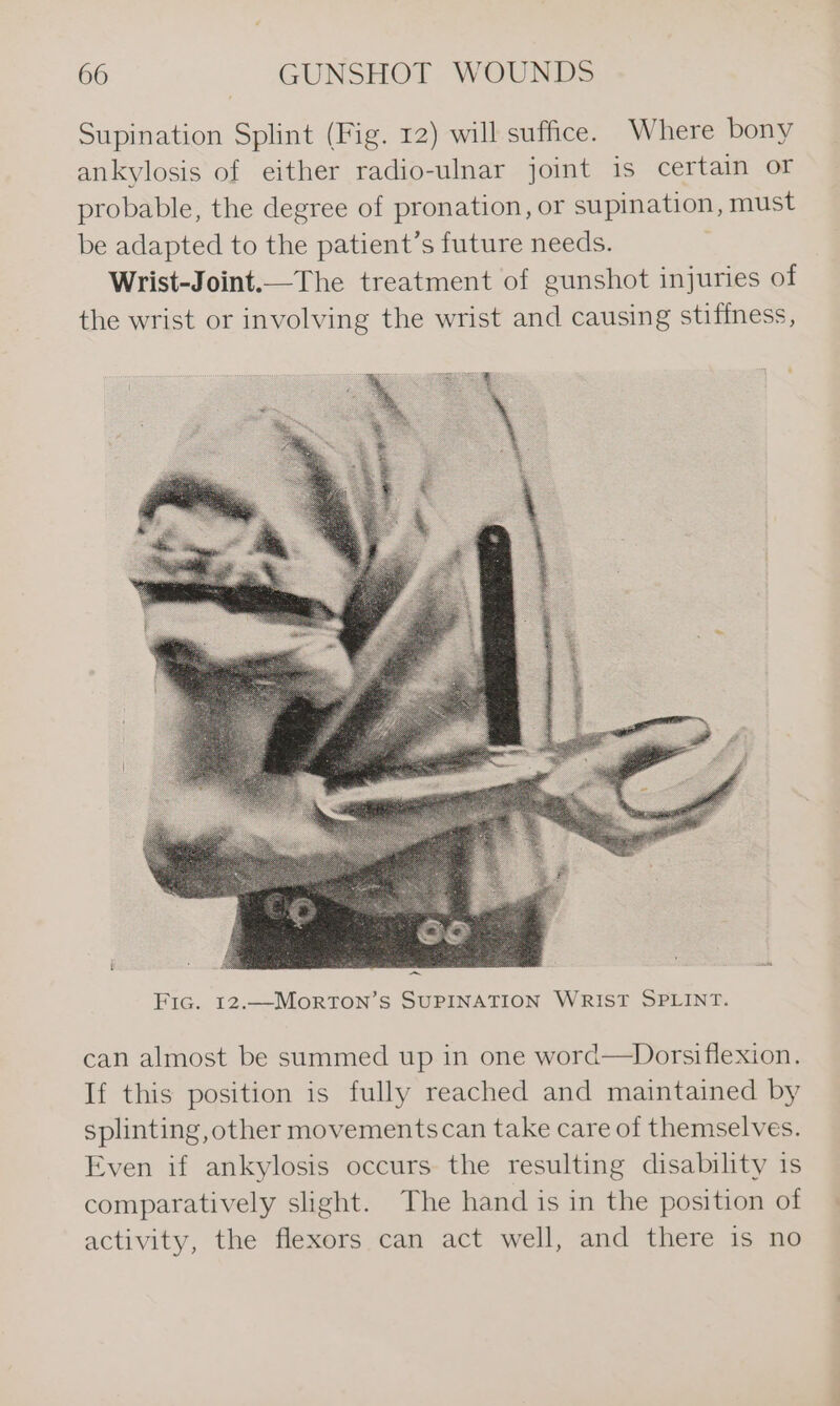 Supination Splint (Fig. 12) will suffice. Where bony ankylosis of either radio-ulnar joint is certain or probable, the degree of pronation, or supination, must be adapted to the patient’s future needs. Wrist-Joint.—The treatment of gunshot injuries of the wrist or involving the wrist and causing stiffness, can almost be summed up in one word—Dorsiflexion. If this position is fully reached and maintained by splinting, other movementscan take care of themselves. Even if ankylosis occurs the resulting disability is comparatively slight. The hand is in the position of activity, the flexors can act well, and there is no