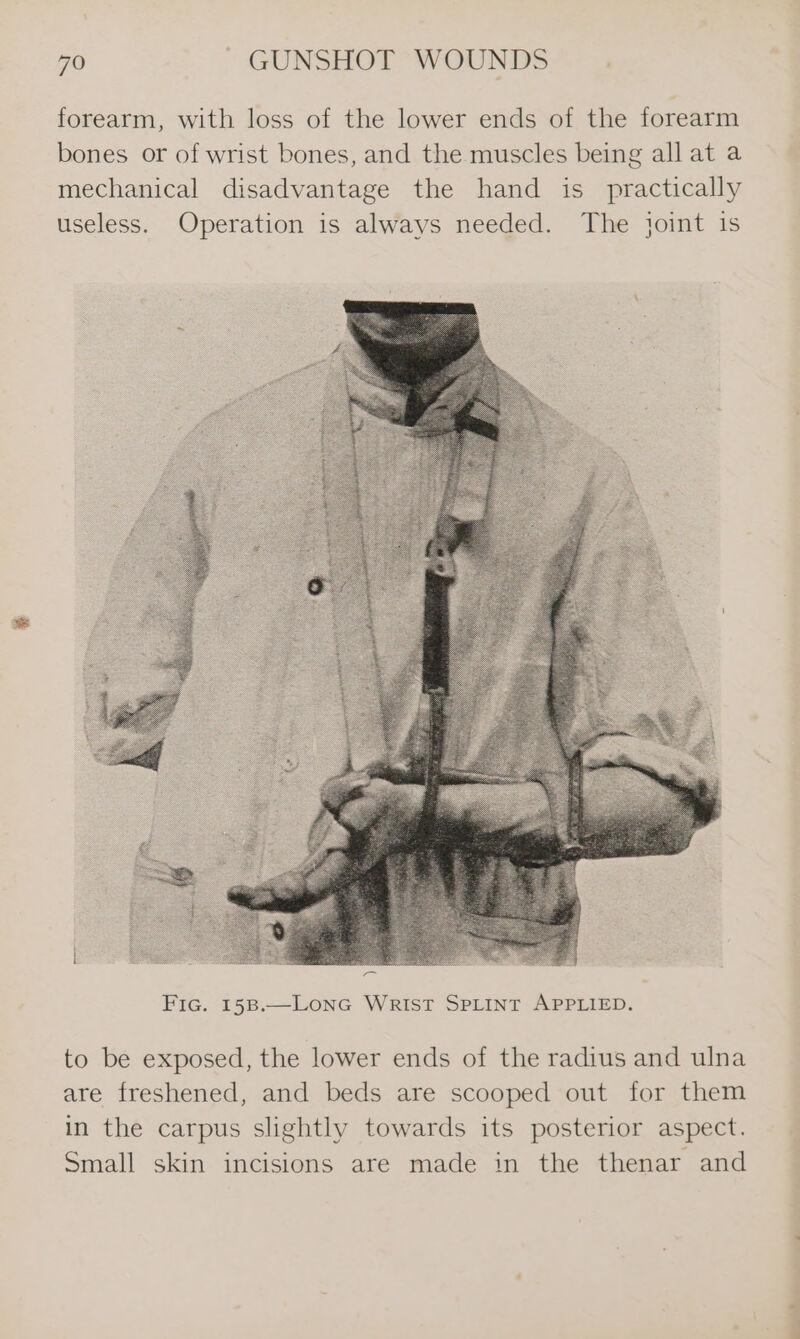 forearm, with loss of the lower ends of the forearm bones or of wrist bones, and the muscles being all at a mechanical disadvantage the hand is practically useless. Operation is always needed. The joint is to be exposed, the lower ends of the radius and ulna are freshened, and beds are scooped out for them in the carpus slightly towards its posterior aspect. Small skin incisions are made in the thenar and