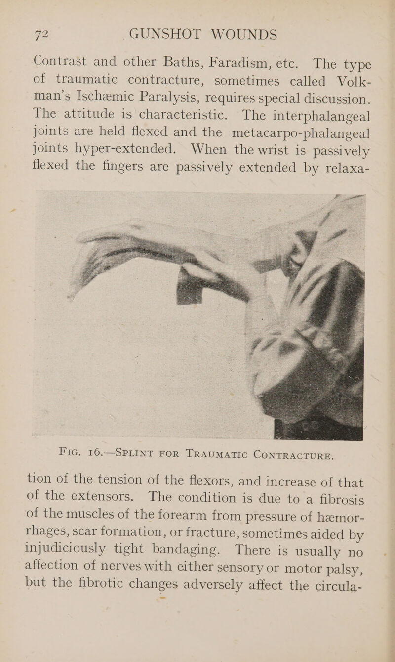 Contrast and other Baths, Faradism, etc. The type of traumatic contracture, sometimes called Volk- man’s Ischemic Paralysis, requires special discussion. The attitude is characteristic. The interphalangeal joints are held flexed and the metacarpo-phalangeal joints hyper-extended. When the wrist is passively flexed the fingers are passively extended by relaxa- SE Oa Fic. 16.—SPLINT FOR TRAUMATIC CONTRACTURE. tion of the tension of the flexors, and increase of that of the extensors. The condition is due to a fibrosis of the muscles of the forearm from pressure of hzemor- rhages, scar formation, or fracture, sometimes aided by injudiciously tight bandaging. There is usually no affection of nerves with either sensory or motor palsy, but the fibrotic changes adversely affect the circula-