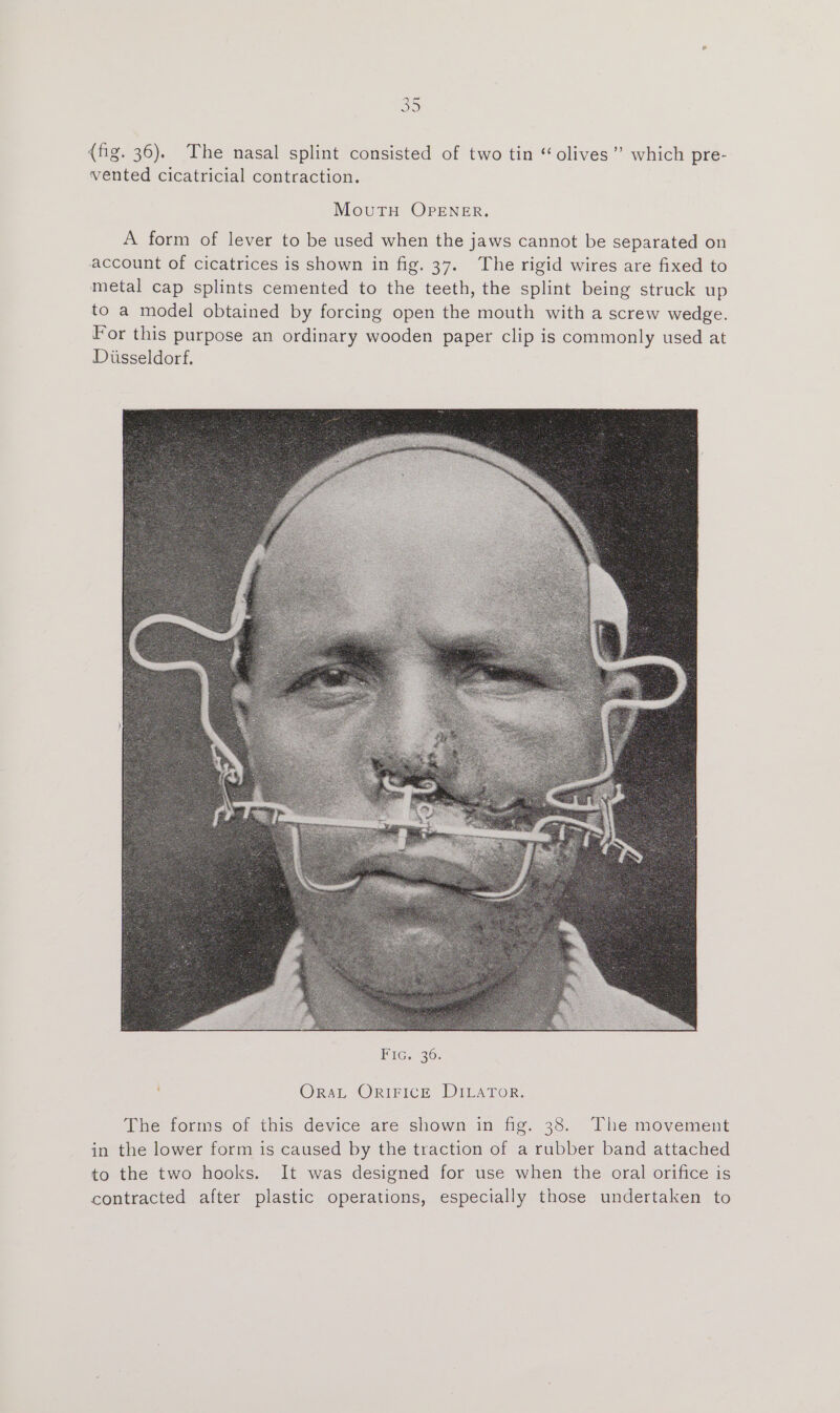 SS {fig. 36). The nasal splint consisted of two tin “ olives” which pre- vented cicatricial contraction. MouTH OPENER, A form of lever to be used when the jaws cannot be separated on account of cicatrices is shown in fig. 37. The rigid wires are fixed to metal cap splints cemented to the teeth, the splint being struck up to a model obtained by forcing open the mouth with a screw wedge. For this purpose an ordinary wooden paper clip is commonly used at Diisseldorf. Oran Orinice DiLAtTor: The forms of this device are shown in fig. 38. The movement in the lower form is caused by the traction of a rubber band attached to the two hooks. It was designed for use when the oral orifice is contracted after plastic operations, especially those undertaken to