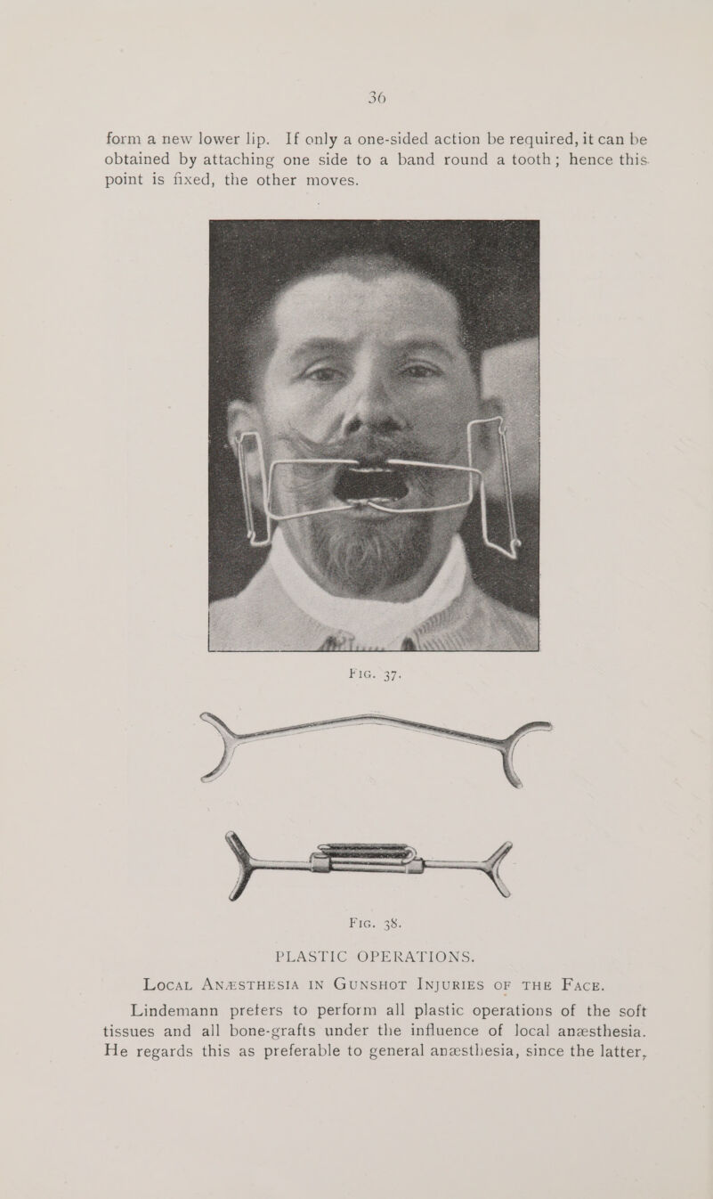 form a new lower lip. If only a one-sided action be required, it can be obtained by attaching one side to a band round a tooth; hence this. point is fixed, the other moves. LocaL ANASTHESIA IN GUNSHOT INJURIES OF THE F AcE. Lindemann preters to perform all plastic operations of the soft tissues and all bone-grafts under the influence of local anesthesia. He regards this as preferable to general anesthesia, since the latter,