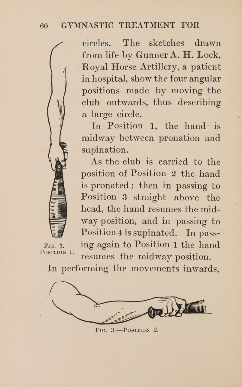 Fie. 3.— Position 1. circles. The sketches drawn from life by Gunner A. H. Lock, Royal Horse Artillery, a patient in hospital, show the four angular positions made by moving the club outwards, thus describing a large circle. In Position 1, the hand is midway between pronation and supination. As the club is carried to the position of Position 2 the hand is pronated ; then in passing to Position 3 straight above the head, the hand resumes the mid- way position, and in passing to Position 4issupinated. In pass- ing again to Position 1 the hand resumes the midway position.