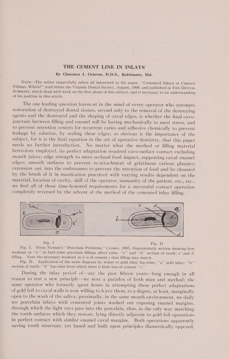 THE CEMENT LINE IN INLAYS By Clarence J. Grieves, D.D.S., Baltimore, Md. NotE—The writer respectfully refers all interested to his paper, ‘‘Cemented Inlays or Contact Fillings, Which?” read before the Virginia Dental Society, August, 1906, and published in THE DENTAL SUMMARY, which deals with work on the first phase of this subject, and is necessary to an understanding of his position in this article. The one leading question foremost in the mind of every operator who attempts restoration of destroyed dental tissues, second only to the removal of the destroying agents and the destroyed and the shaping of caval edges, is whether the final cavo- juncture between filling and enamel will be lasting mechanically to meet stress, and to prevent retention centers for recurrent caries and adhesive chemically to prevent leakage by solution, by sealing these edges; so obvious is the importance of the subject, for it is the final equation in the art of operative dentistry, that this paper needs no further introduction. No matter what the method or filling material heretofore employed, its perfect adaptation required cavo-surface contact excluding mouth juices; edge strength to meet occlusal food impact, supporting caval enamel edges; smooth surfaces to prevent re-attachment of gelatinous carious plaques; extension out into the embrasures to prevent the retention of food and be cleansed by the brush of it in mastication practiced with varying results dependent on the material, location of cavity, skill cf the operator, immunity of the patient, etc., etc., we find all of these time-honored requirements for a successful contact operation completely reversed by the advent of the method of the cemented inlay filling. an) washout at “o’’ in butt-joint porcelain fillings affect color, “‘e’’ and ‘‘d”’ section of tooth; e’ and d’ filling. Note the necessary washout at o’-o of cement c that filling may match. Fig. II. Application of the same diagram by writer to gold inlay lap-joint; ‘“‘a’’ gold inlay; ‘‘b”’ section of tooth; “‘d”’ lap-joint from which there is little loss of cement “‘c.”’ During the inlay period of—say the past fifteen years—long enough in all reason to test a new principle—we note a paradox of both man and method: the same operator who formerly spent hours in attempting these perfect adaptations of gold foil to caval walls is now willing to leave them, to a degree, at least, marginally open to the wash of the saliva; proximally, in the same mouth environment, we daily see porcelain inlays with cemented joints washed out exposing enamel margins, through which the light rays pass into the porcelain, thus, in the only way matching the tooth surfaces which they restore, lying directly adjacent to gold foil operations in perfect contact with similar enamel caval margins. Both operations apparently saving tooth structure, yet based and built upon principles diametrically opposed,