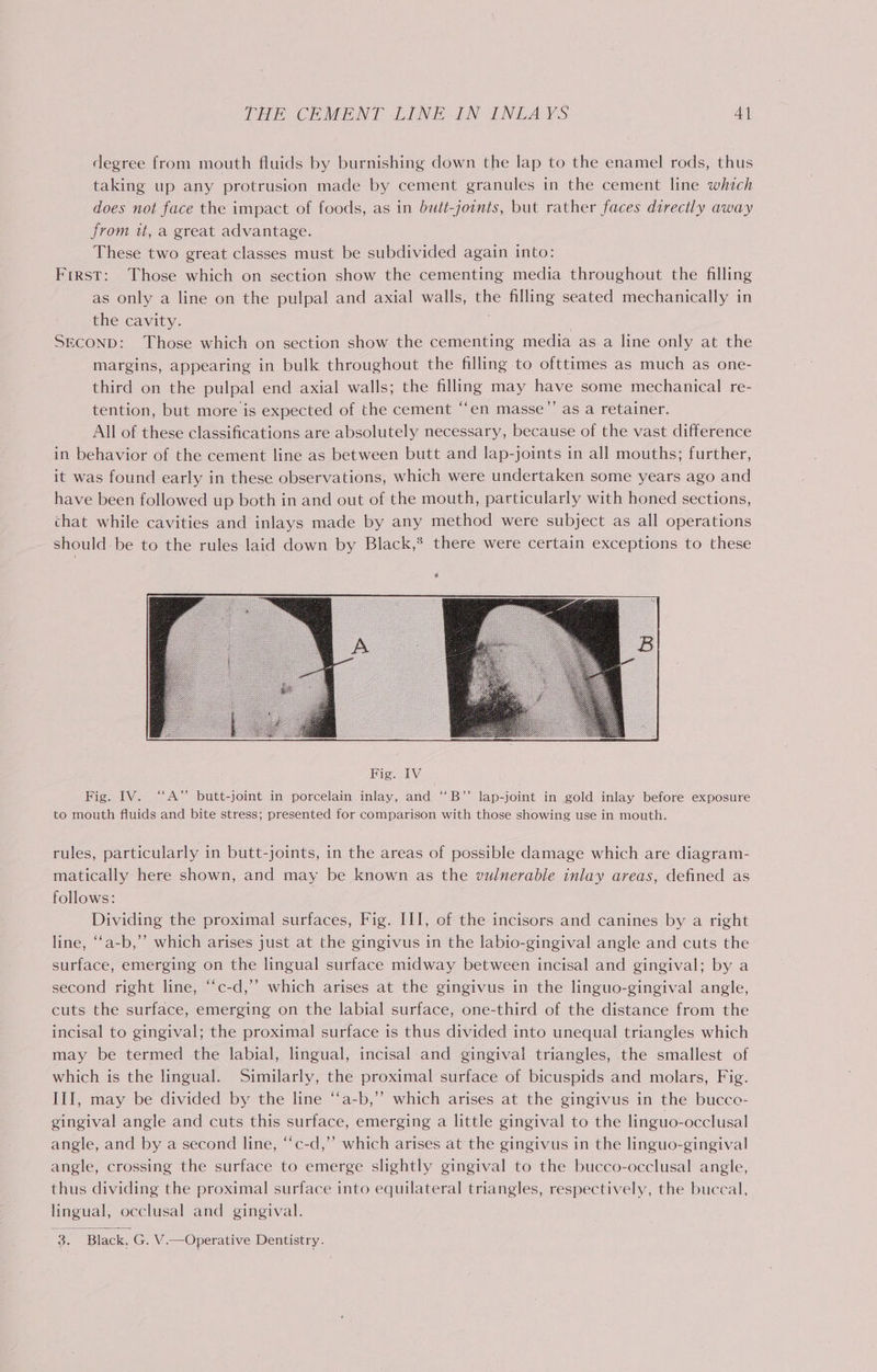 degree from mouth fluids by burnishing down the lap to the enamel rods, thus taking up any protrusion made by cement granules in the cement line which does not face the impact of foods, as in batt-joints, but rather faces directly away from it, a great advantage. These two great classes must be subdivided again into: Frrst: Those which on section show the cementing media throughout the filling as only a line on the pulpal and axial walls, the filling seated mechanically in the cavity. | SECOND: Those which on section show the cementing media as a line only at the margins, appearing in bulk throughout the filling to ofttimes as much as one- third on the pulpal end axial walls; the filling may have some mechanical re- tention, but more is expected of the cement “en masse”’ as a retainer. All of these classifications are absolutely necessary, because of the vast difference in behavior of the cement line as between butt and lap-joints in all mouths; further, it was found early in these observations, which were undertaken some years ago and have been followed up both in and out of the mouth, particularly with honed sections, chat while cavities and inlays made by any method were subject as all operations should be to the rules laid down by Black,® there were certain exceptions to these @ rules, particularly in butt-joints, in the areas of possible damage which are diagram- matically here shown, and may be known as the vulnerable inlay areas, defined as follows: Dividing the proximal surfaces, Fig. III, of the incisors and canines by a right line, ‘‘a-b,’’ which arises just at the gingivus in the labio-gingival angle and cuts the surface, emerging on the lingual surface midway between incisal and gingival; by a second right line, ‘“c-d,’’ which arises at the gingivus in the linguo-gingival angle, cuts the surface, emerging on the labial surface, one-third of the distance from the incisal to gingival; the proximal surface is thus divided into unequal triangles which may be termed the labial, lingual, incisal and gingival triangles, the smallest of which is the lingual. Similarly, the proximal surface of bicuspids and molars, Fig. III, may be divided by the line ‘‘a-b,” which arises at the gingivus in the bucco- gingival angle and cuts this surface, emerging a little gingival to the linguo-occlusal angle, and by a second line, ‘“‘c-d,”’ which arises at the gingivus in the linguo-gingival angle, crossing the surface to emerge slightly gingival to the bucco-occlusal angle, thus dividing the proximal surface into equilateral triangles, respectively, the buccal, lingual, occlusal and gingival. 3. Black, G. V.—Operative Dentistry.