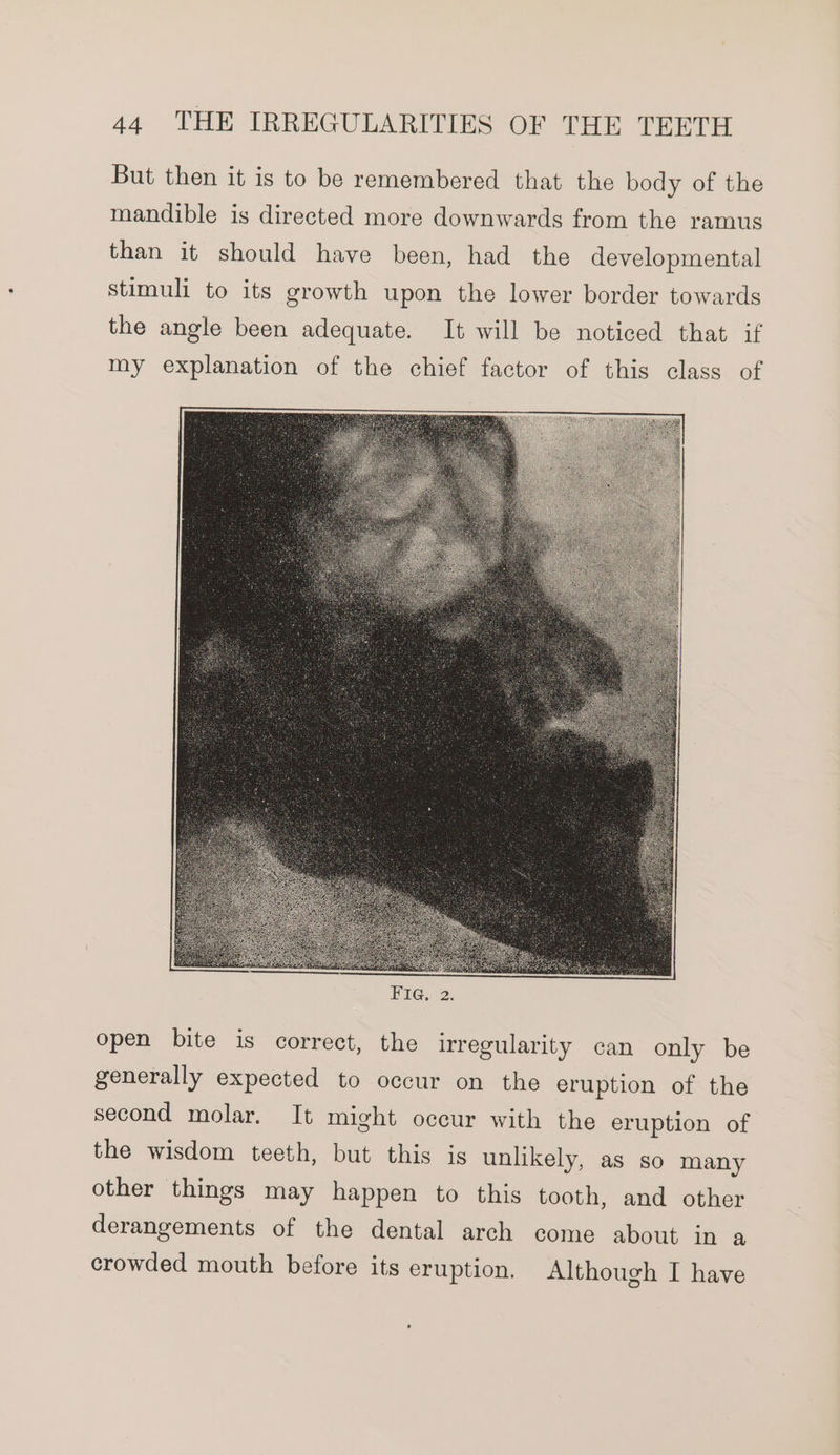 But then it is to be remembered that the body of the mandible is directed more downwards from the ramus than it should have been, had the developmental stimuli to its growth upon the lower border towards the angle been adequate. It will be noticed that if my explanation of the chief factor of this class of open bite is correct, the irregularity can only be generally expected to occur on the eruption of the second molar. It might occur with the eruption of the wisdom teeth, but this is unlikely, as so many other things may happen to this tooth, and other derangements of the dental arch come about in a crowded mouth before its eruption. Although I have