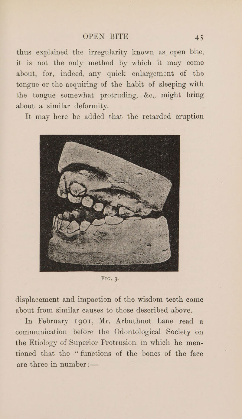 thus explained the irregularity known as open bite, it is not the only method by which it may come about, for, indeed, any quick enlargement of the tongue or the acquiring of the habit of sleeping with the tongue somewhat protruding, &amp;c., might bring about a similar deformity. It may here be added that the retarded eruption displacement and impaction of the wisdom teeth come about from similar causes to those described above. In February 1901, Mr. Arbuthnot Lane read a communication before the Odontological Society on the Etiology of Superior Protrusion, in which he men- tioned that the “functions of the bones of the face are three in number :—