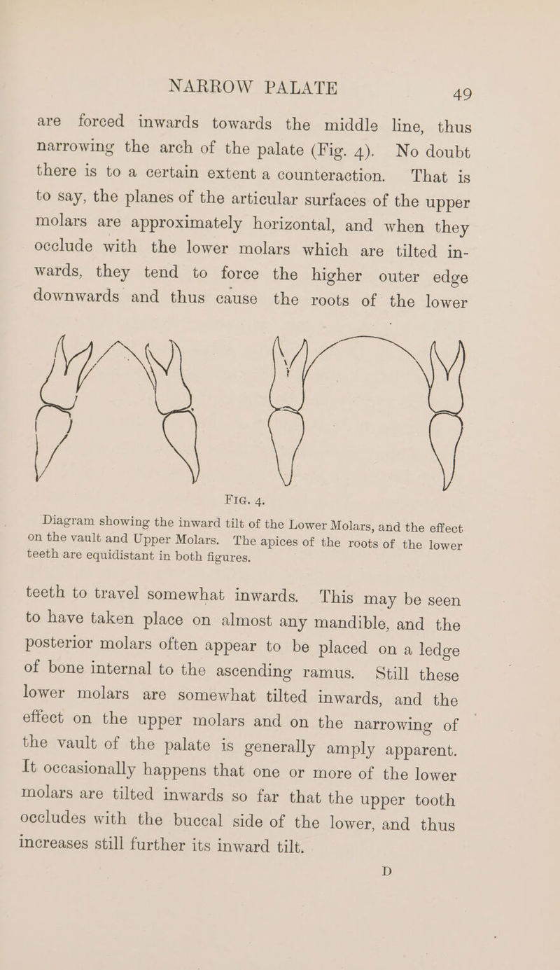 are forced inwards towards the middle line, thus narrowing the arch of the palate (Fig. 4). No doubt there is to a certain extent a counteraction. That is to say, the planes of the articular surfaces of the upper molars are approximately horizontal, and when they occlude with the lower molars which are tilted in- wards, they tend to force the higher outer edge downwards and thus cause the roots of the lower Axe: Diagram showing the inward tilt of the Lower Molars, and the effect on the vault and Upper Molars. The apices of the roots of the lower teeth are equidistant in both figures. . FIG. 4. teeth to travel somewhat inwards. This may be seen to have taken place on almost any mandible, and the posterior molars often appear to be placed on a ledge of bone internal to the ascending ramus. Still these lower molars are somewhat tilted inwards, and the effect on the upper molars and on the narrowing of the vault of the palate is generally amply apparent. It occasionally happens that one or more of the lower molars are tilted inwards so far that the upper tooth occludes with the buccal side of the lower, and thus increases still further its inward tilts D