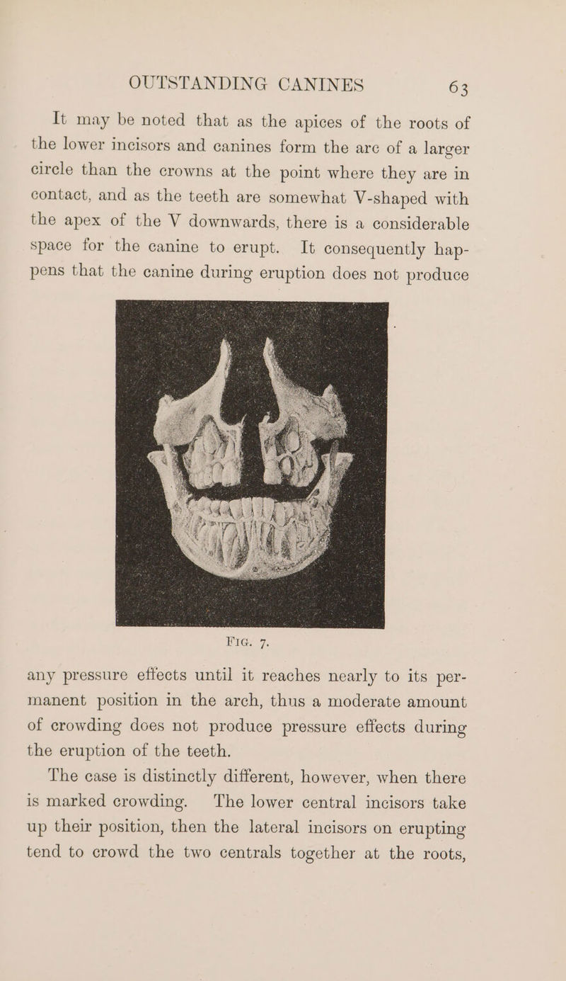 It may be noted that as the apices of the roots of the lower incisors and canines form the arc of a larger circle than the crowns at the point where they are in contact, and as the teeth are somewhat V-shaped with the apex of the V downwards, there is a considerable space for the canine to erupt. It consequently hap- pens that the canine during eruption does not produce Fia. 7. any pressure effects until it reaches nearly to its per- manent position in the arch, thus a moderate amount of crowding does not produce pressure effects during the eruption of the teeth. The case is distinctly different, however, when there is marked crowding. The lower central incisors take up their position, then the lateral incisors on erupting tend to crowd the two centrals together at the roots,