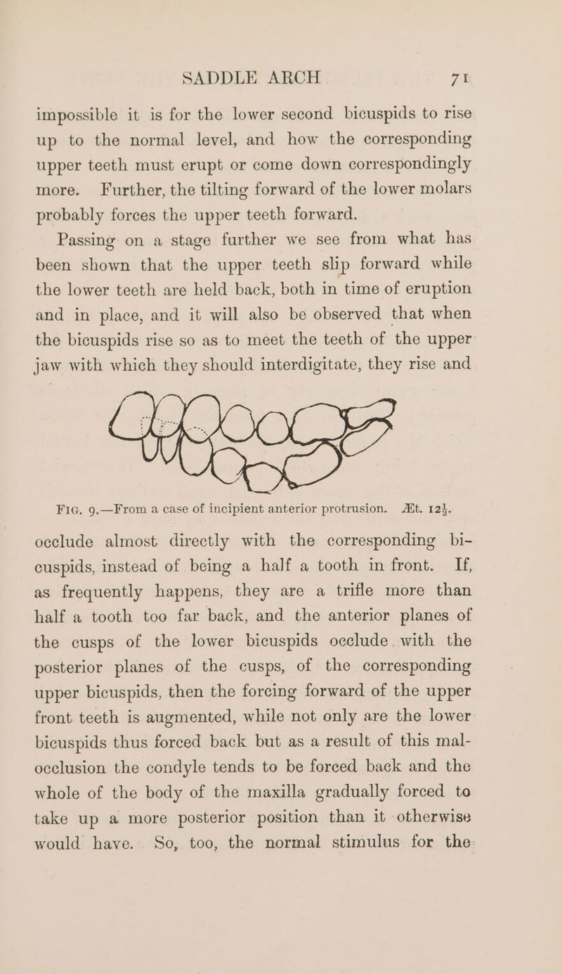 impossible it is for the lower second bicuspids to rise up to the normal level, and how the corresponding upper teeth must erupt or come down correspondingly more. Further, the tilting forward of the lower molars probably forces the upper teeth forward. Passing on a stage further we see from what has been shown that the upper teeth slip forward while the lower teeth are held back, both in time of eruption and in place, and it will also be observed that when the bicuspids rise so as to meet the teeth of the upper jaw with which they should interdigitate, they rise and Fic. 9.—From a case of incipient anterior protrusion. Alt. 124. occlude almost directly with the corresponding bi- cuspids, instead of being a half a tooth in front. If, as frequently happens, they are a trifle more than half a tooth too far back, and the anterior planes of the cusps of the lower bicuspids occlude with the posterior planes of the cusps, of the corresponding upper bicuspids, then the forcing forward of the upper front. teeth is augmented, while not only are the lower bicuspids thus forced back but as a result of this mal- occlusion the condyle tends to be forced back and the whole of the body of the maxilla gradually forced to take up a more posterior position than it otherwise would have. So, too, the normal stimulus for the: