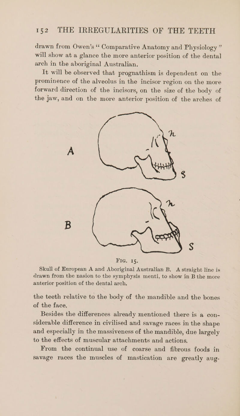 drawn from Owen’s ‘‘ Comparative Anatomy and Physiology ” will show at a glance the more anterior position of the dental arch in the aboriginal Australian. It will be observed that prognathism is dependent on the prominence of the alveolus in the incisor region on the more forward direction of the incisors, on the size of the body of the jaw, and on the more anterior position of the arches of Skull of European A and Aboriginal Australian B. A straight line is drawn from the nasion to the symphysis menti, to show in B the more anterior position of the dental arch, the teeth relative to the body of the mandible and the bones of the face. Besides the differences already mentioned there is a con- siderable difference in civilised and savage races in the shape and especially in the massiveness of the mandible, due largely to the effects of muscular attachments and actions. From the continual use of coarse and fibrous foods in savage races the muscles of mastication are greatly aug-